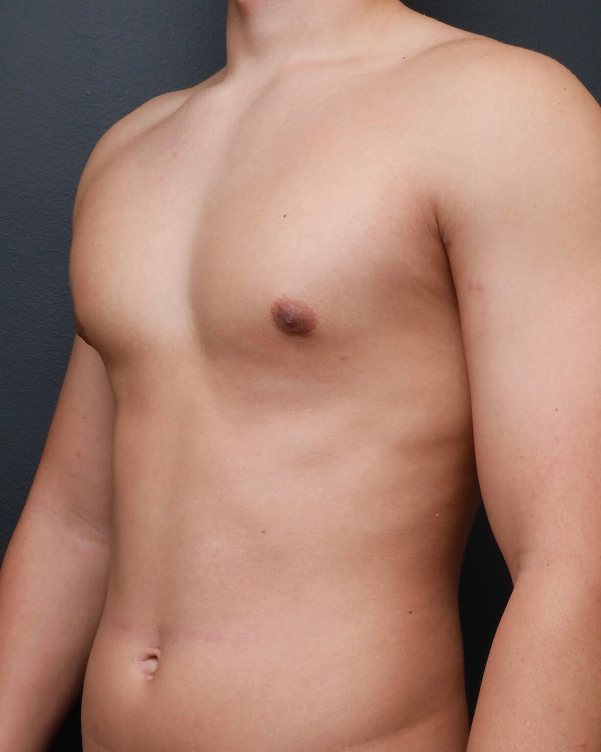 Left Oblique After