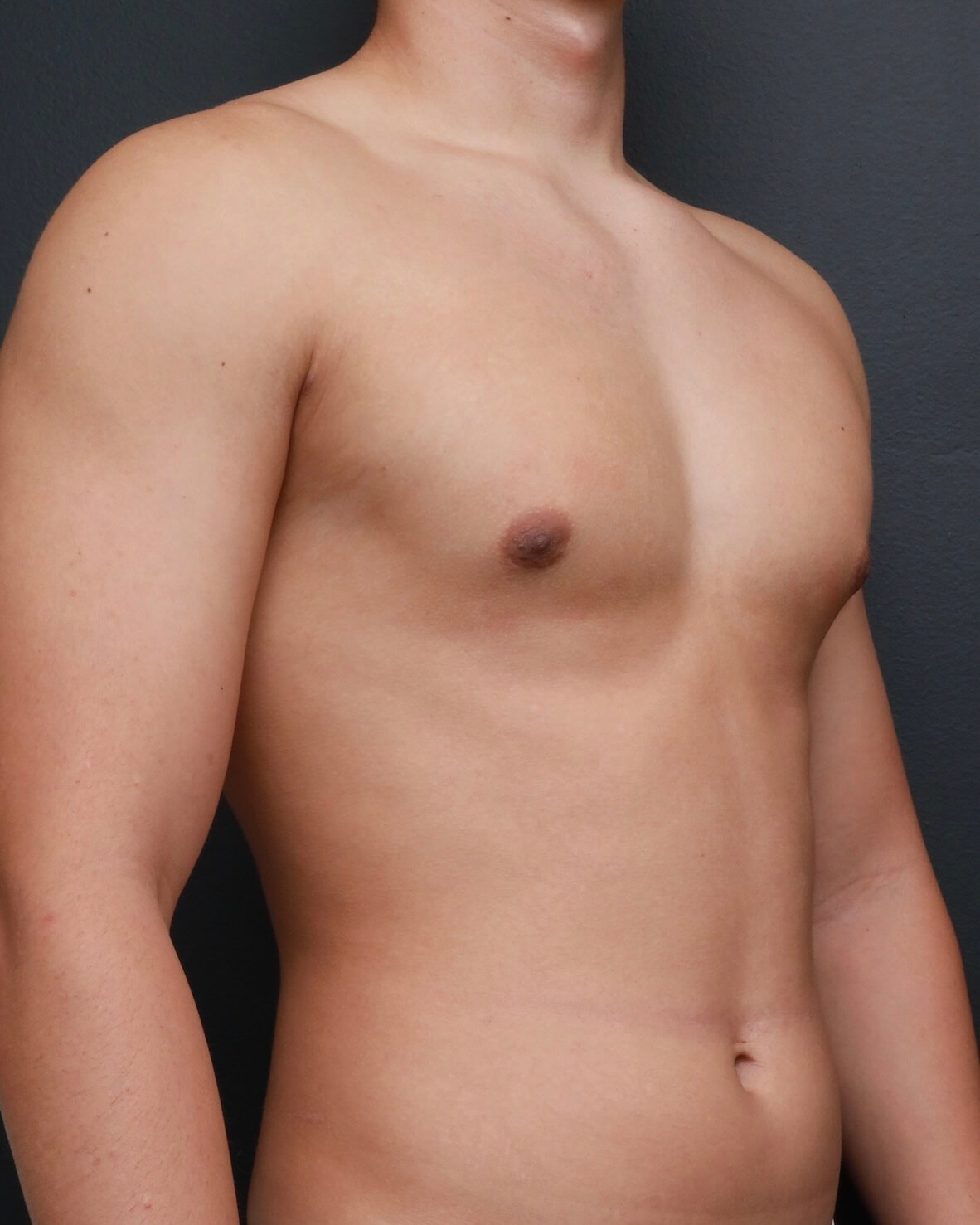 Right Oblique After