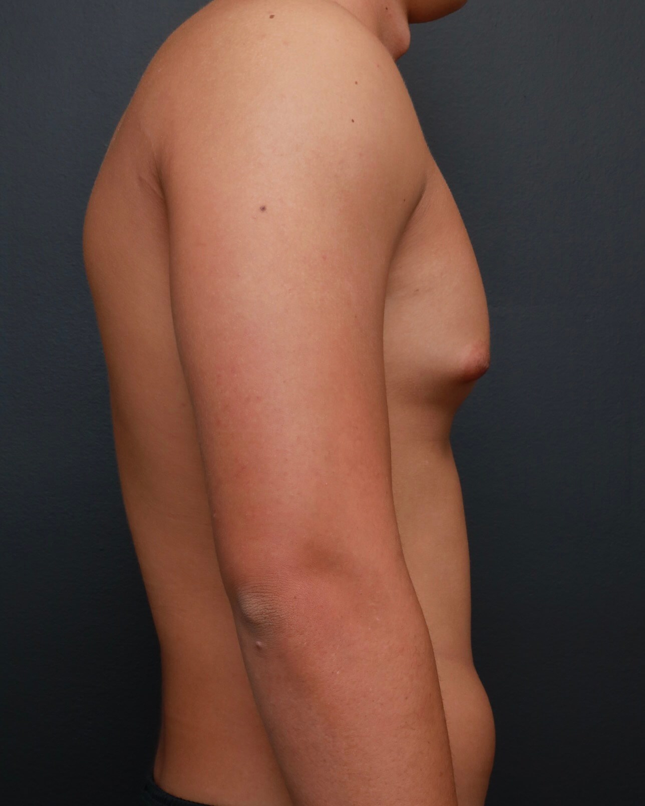 Right Lateral Before