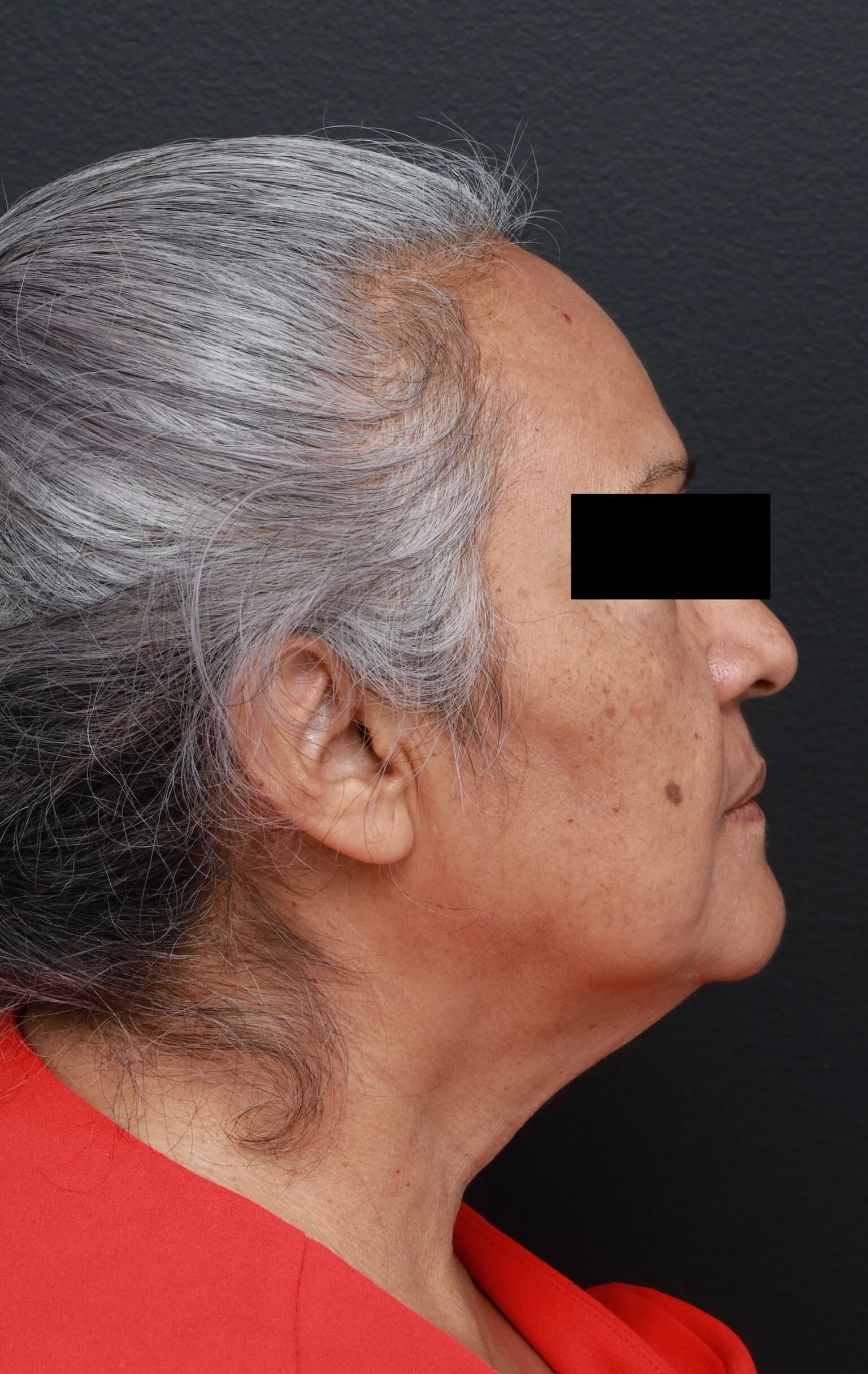 Right Lateral Before