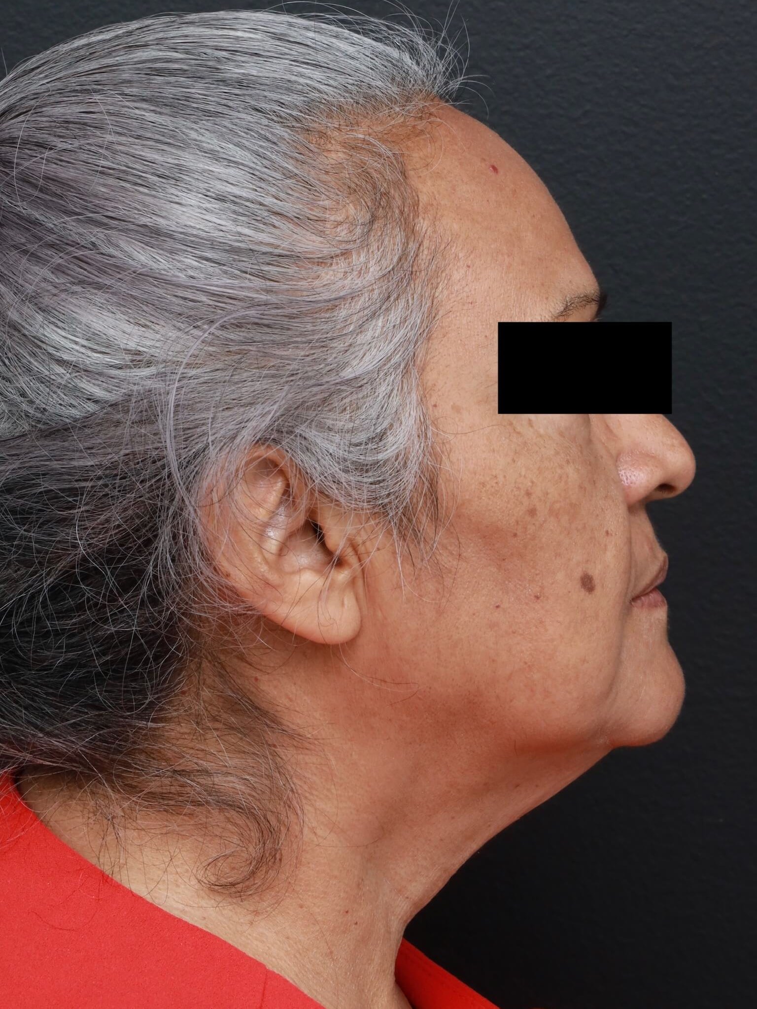 Right Lateral Before