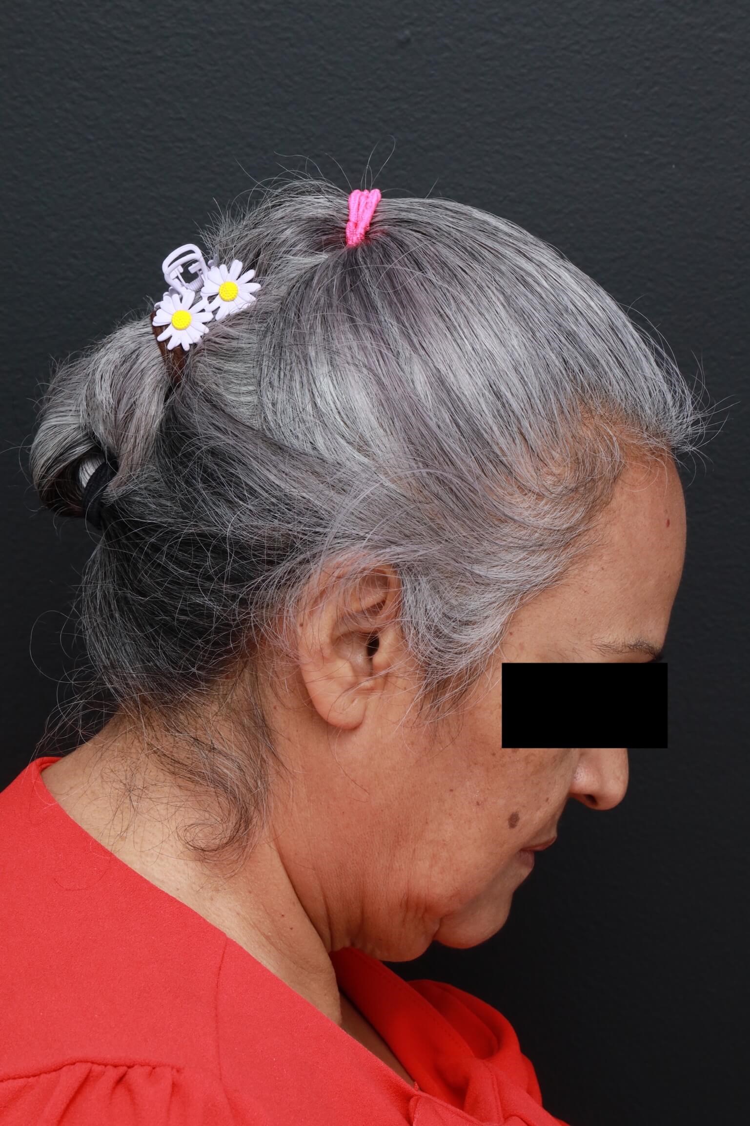 Right Lateral Neck Flexed Before