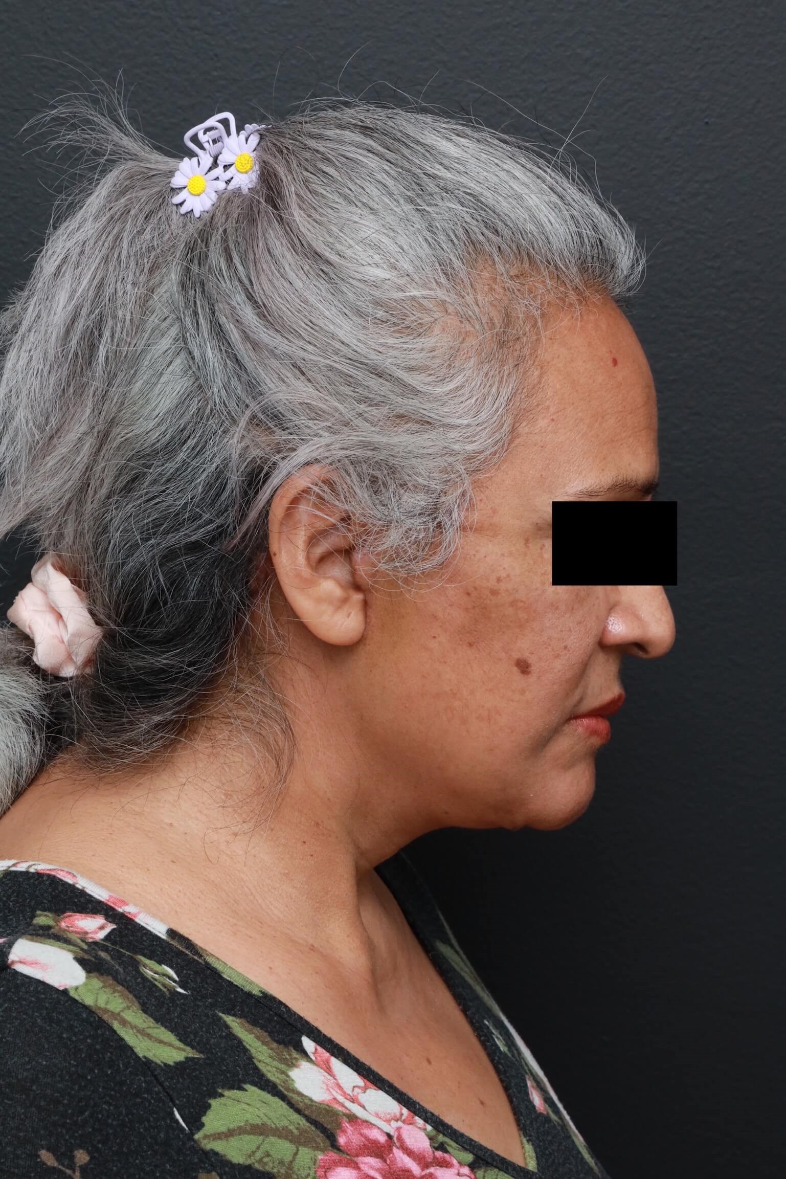Right Lateral Neck Flexed After