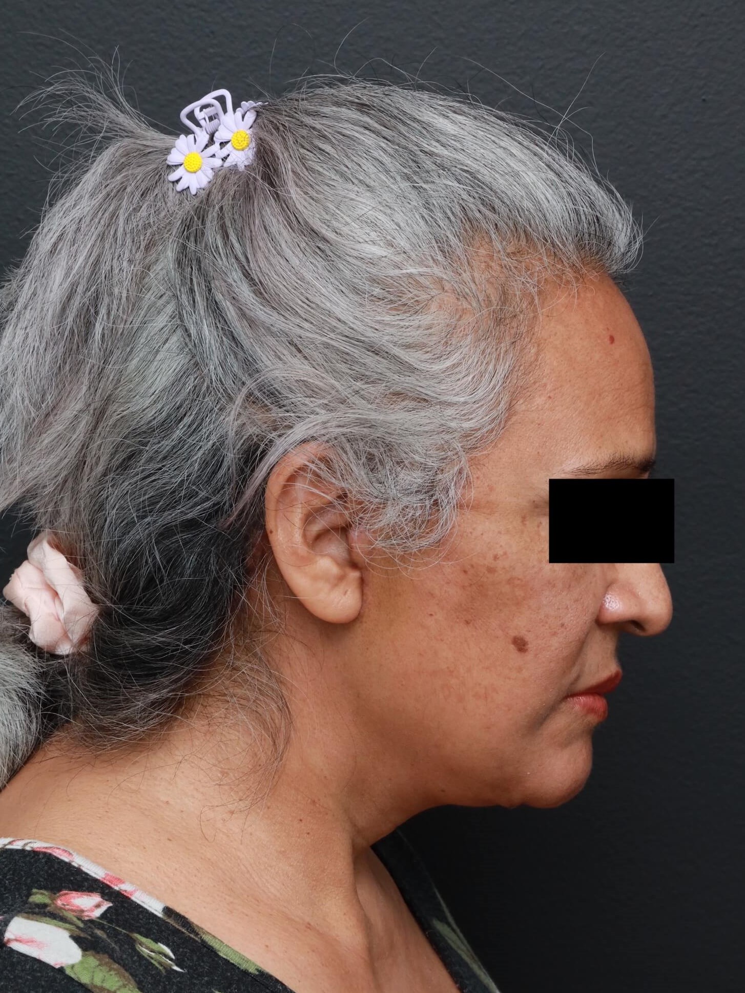 Right Lateral Neck Flexed After