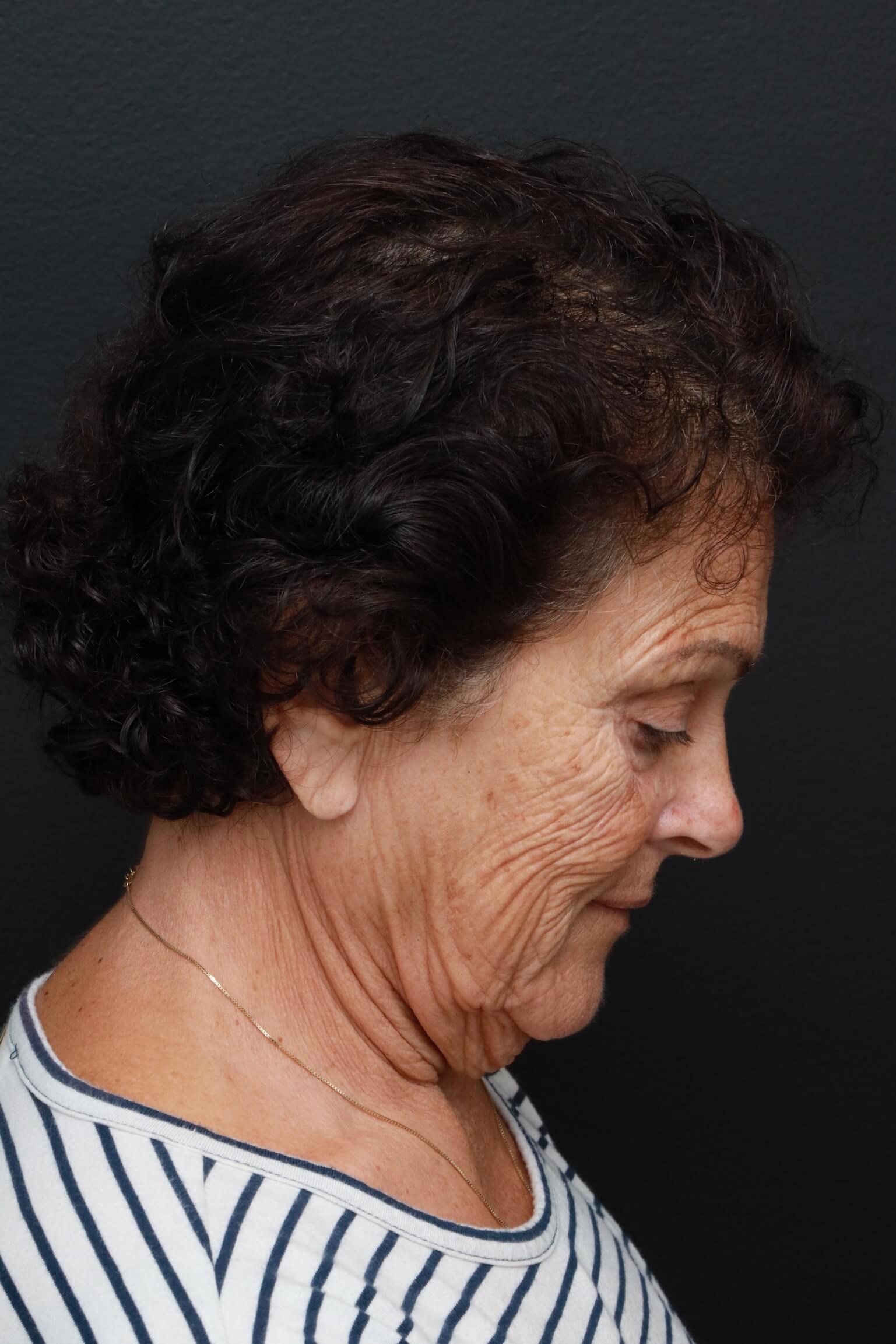 Right Lateral Neck Flexed Before