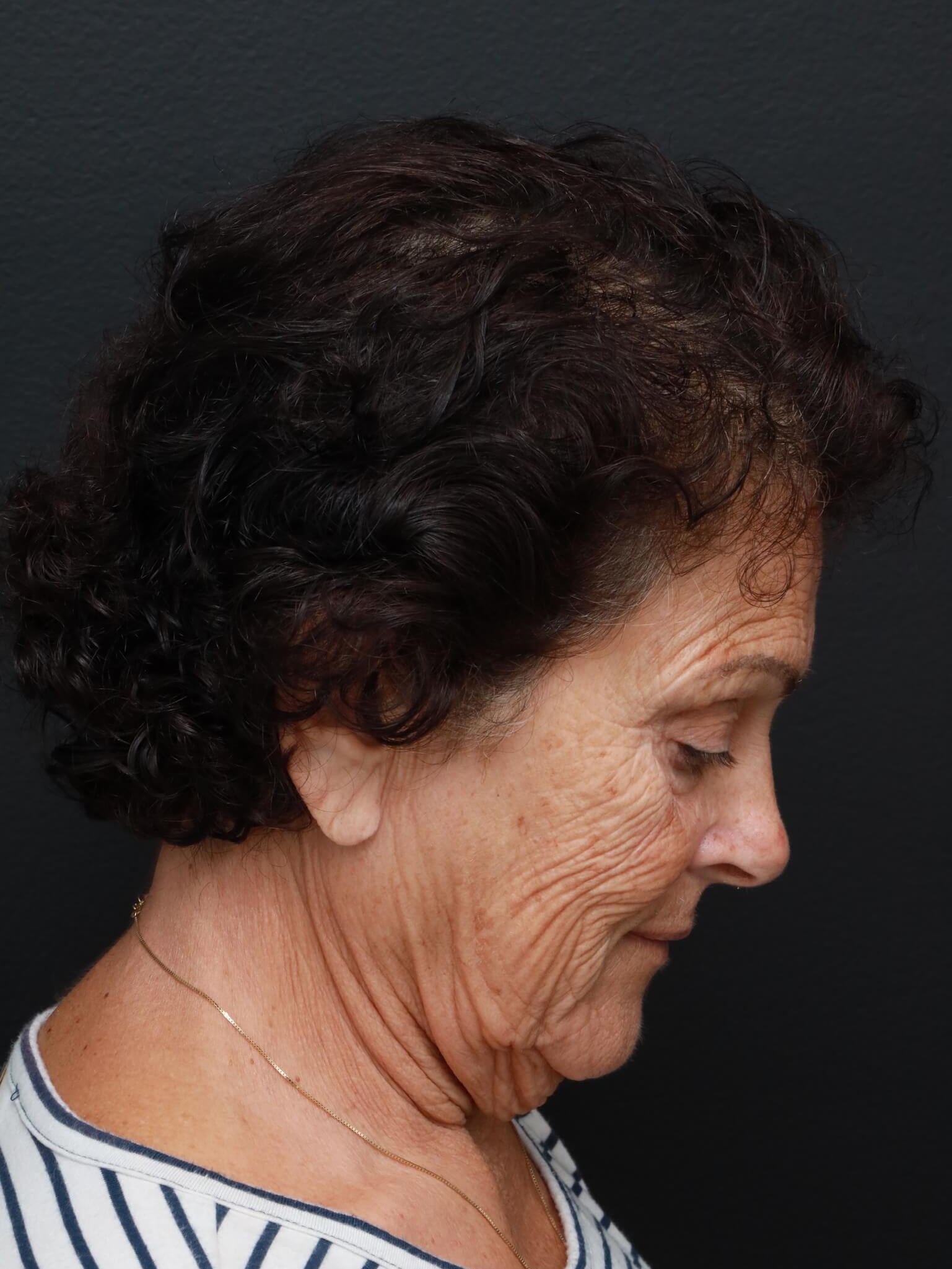 Right Lateral Neck Flexed Before