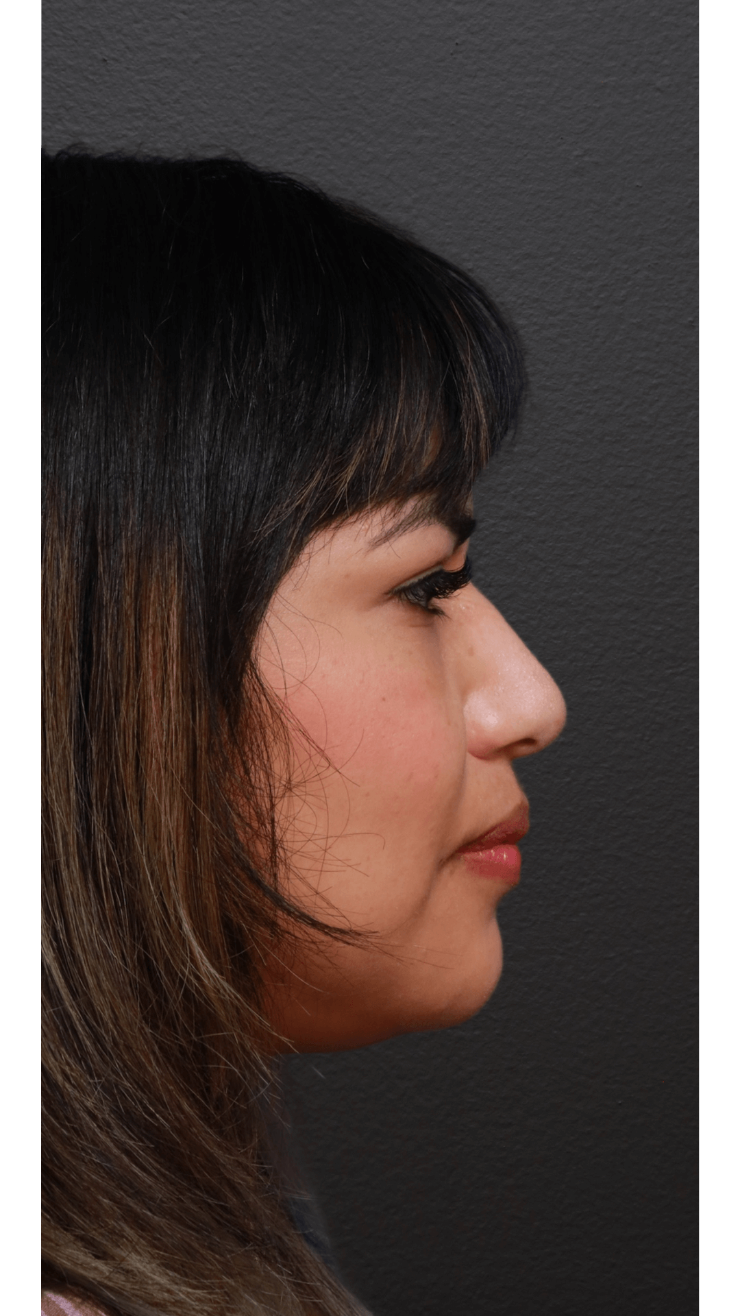 Right Lateral After