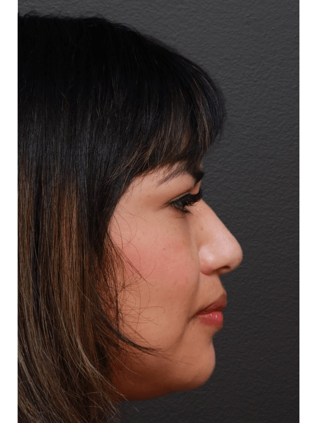 Right Lateral After