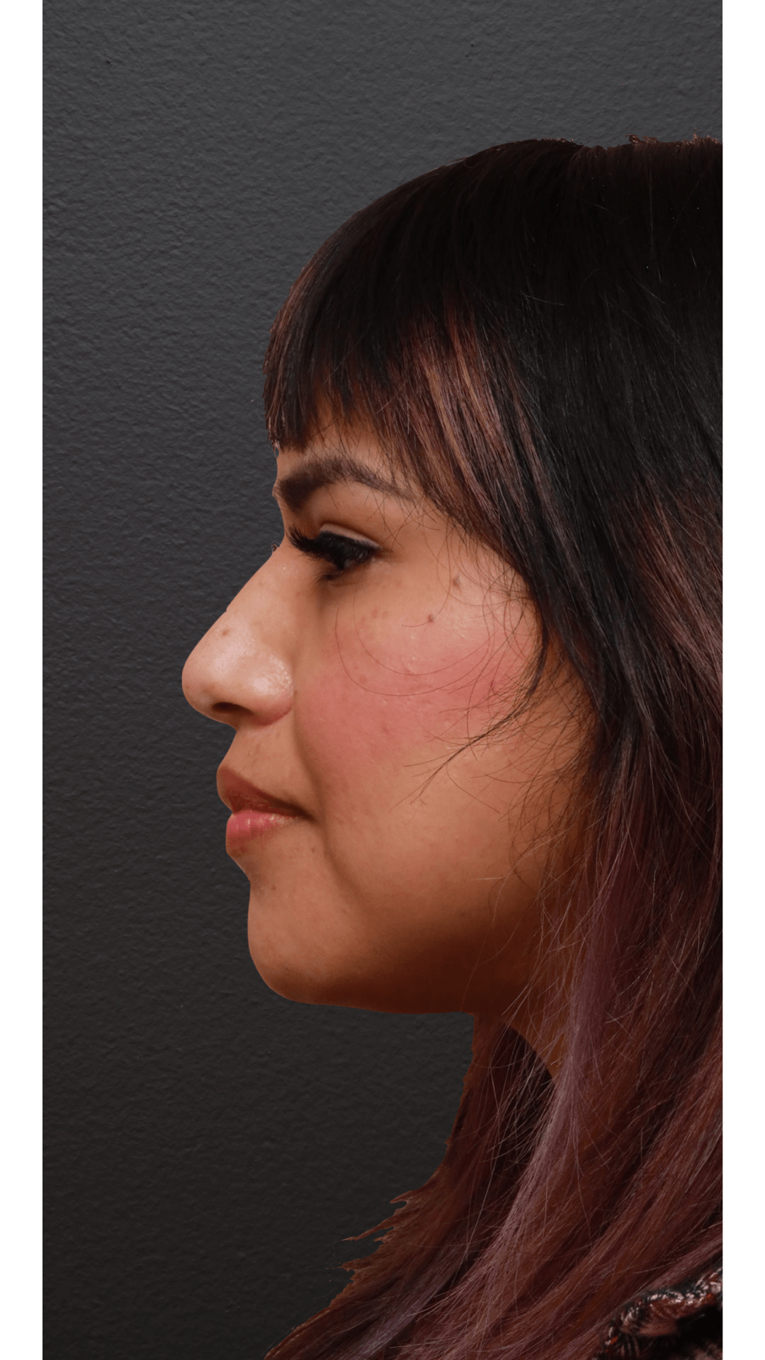 Left Lateral Before
