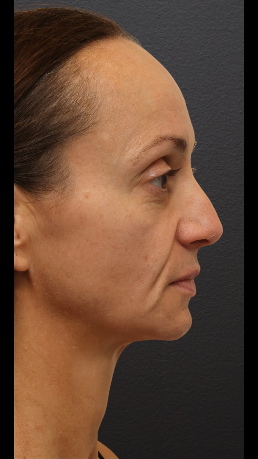 Right Lateral Before
