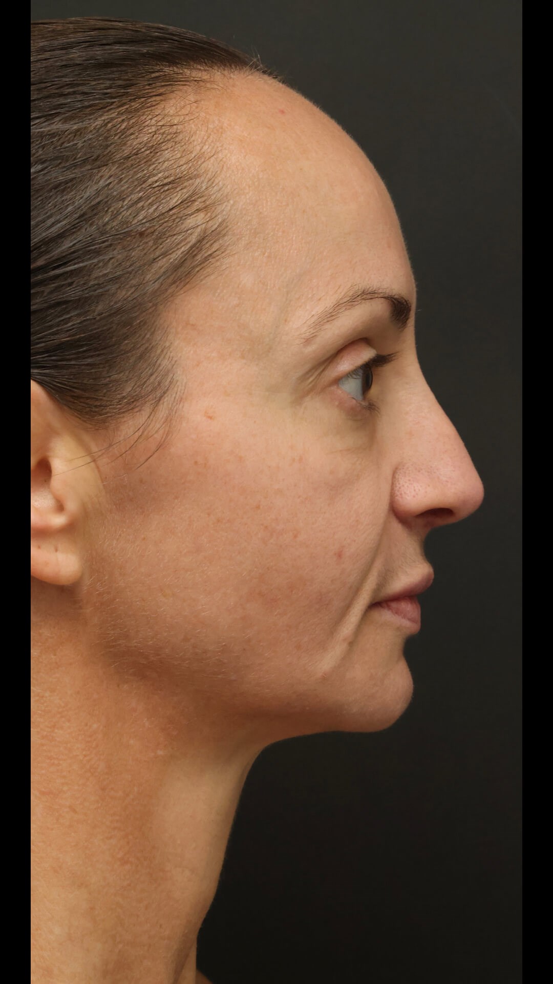 Right Lateral After