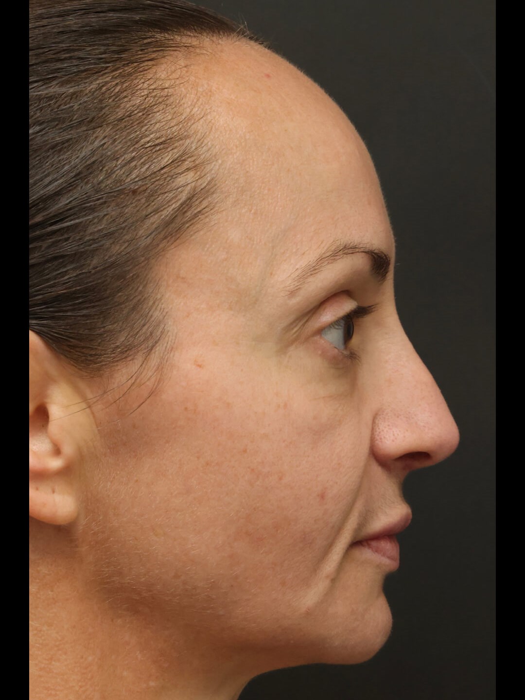 Right Lateral After