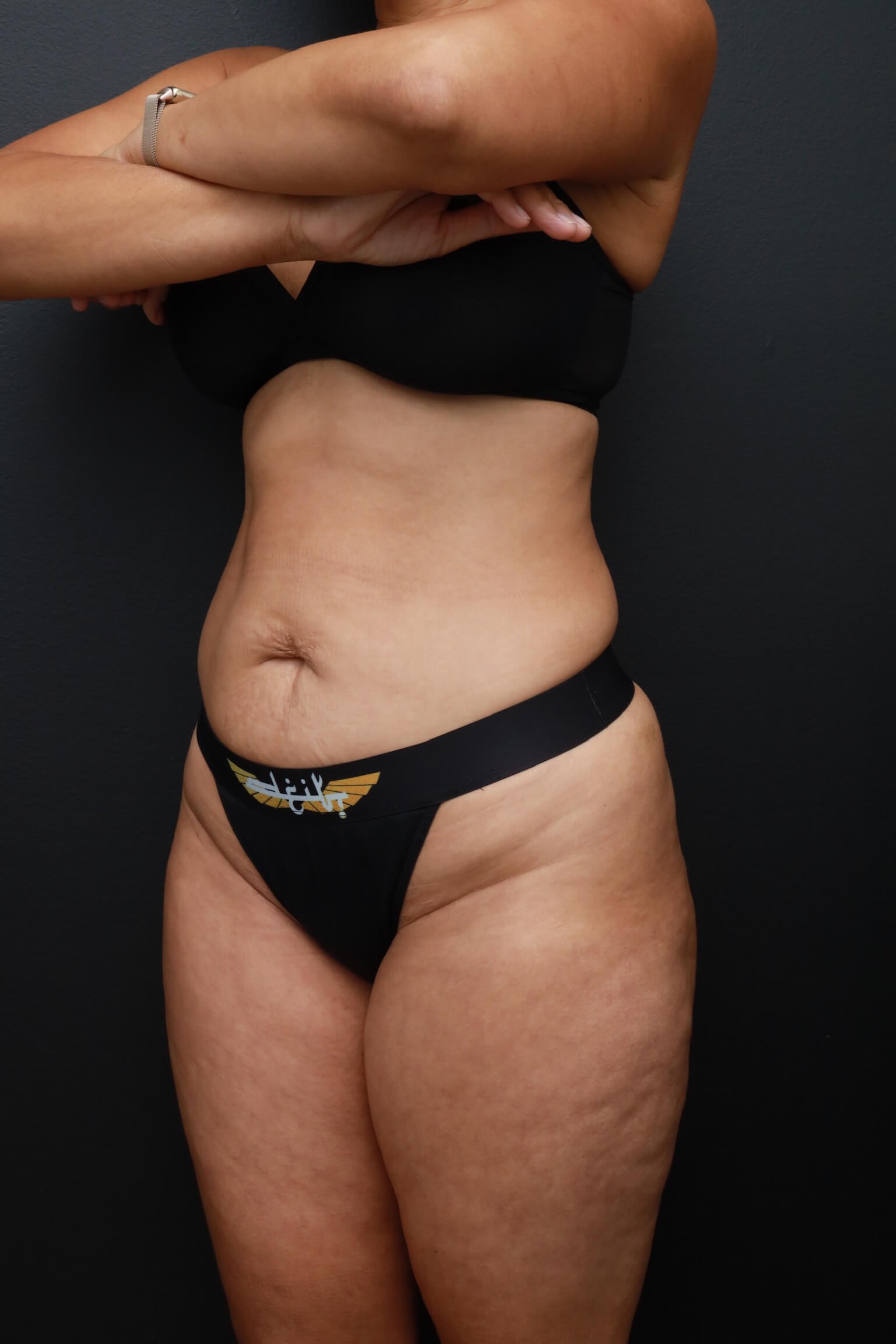 Left Oblique Before