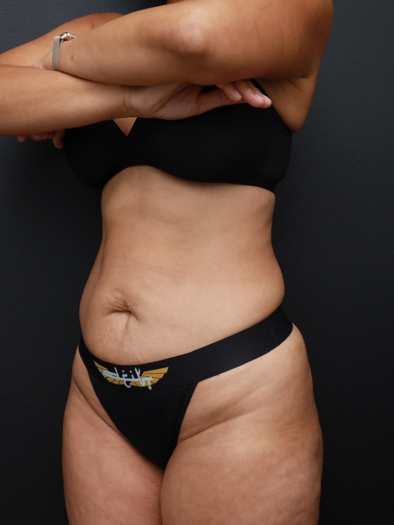 Left Oblique Before