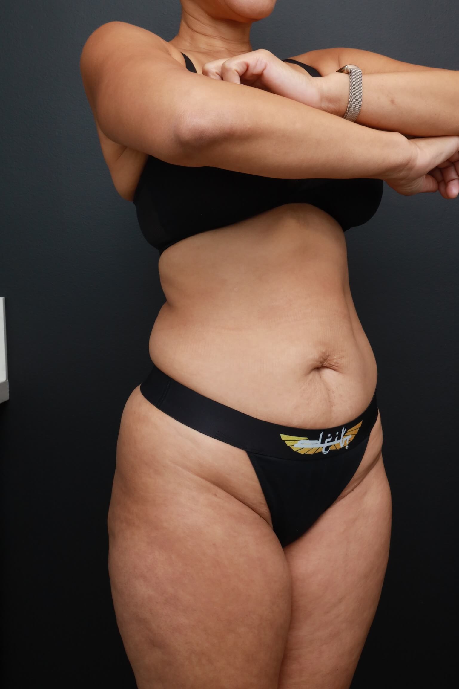 Right Oblique Before