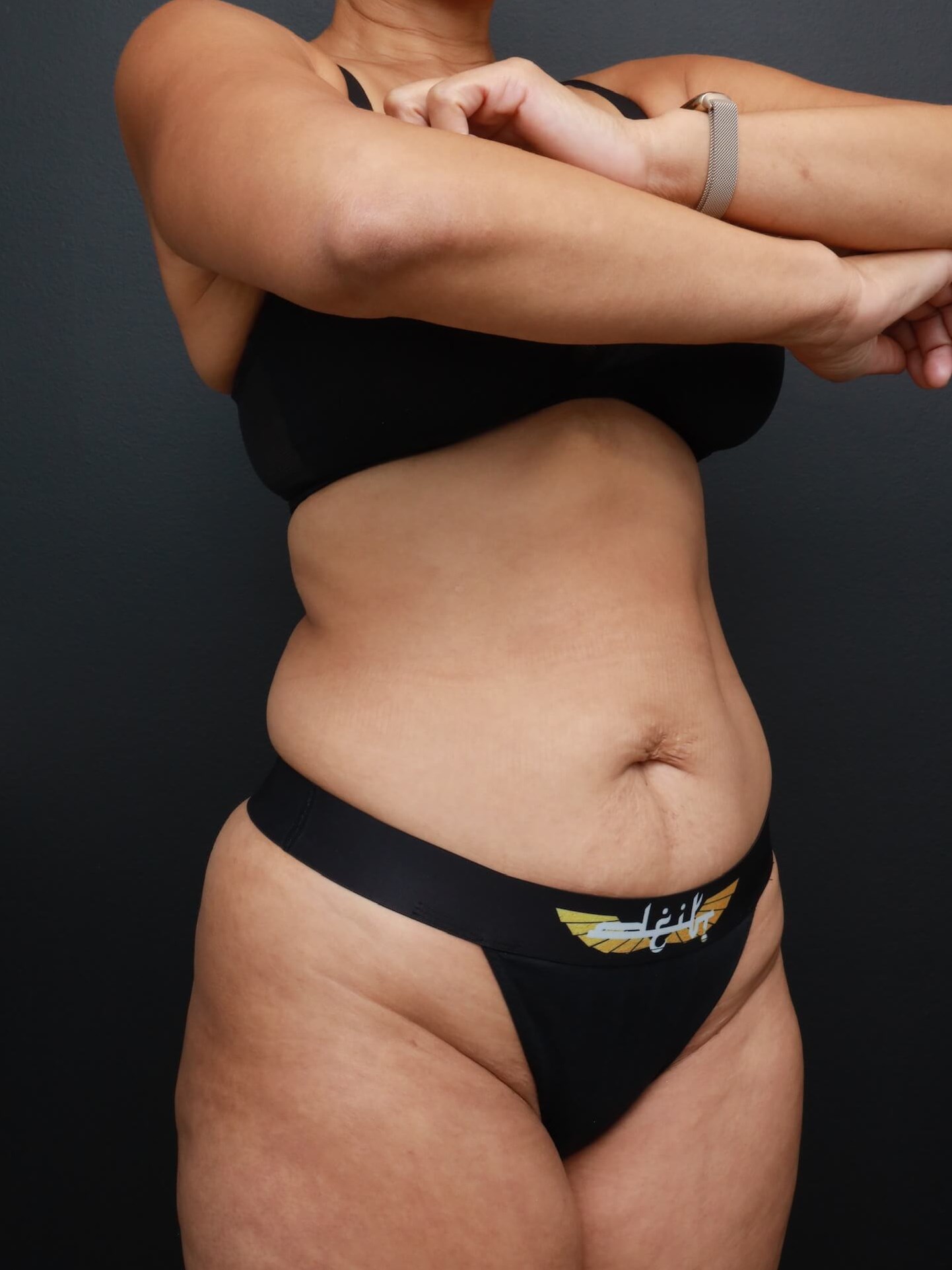 Right Oblique Before