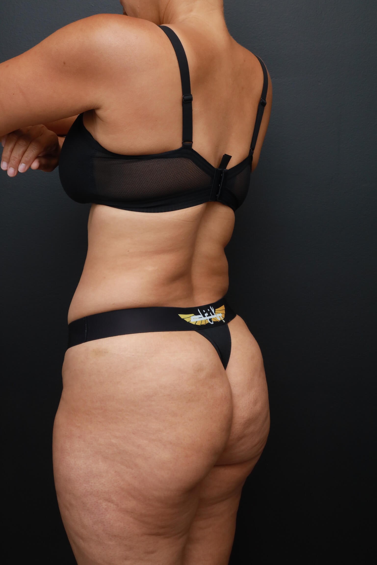 Left Back Oblique Before