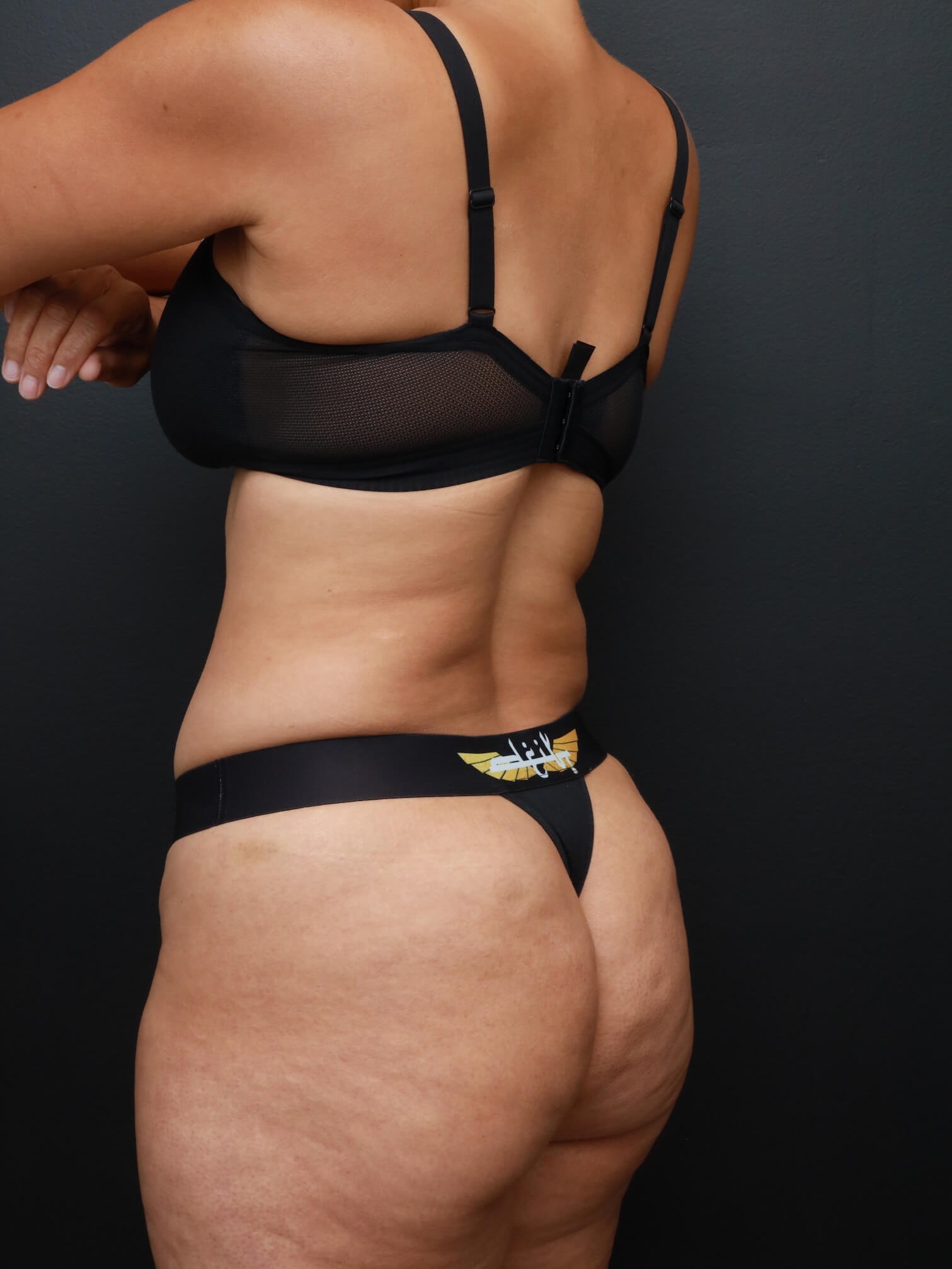 Left Back Oblique Before