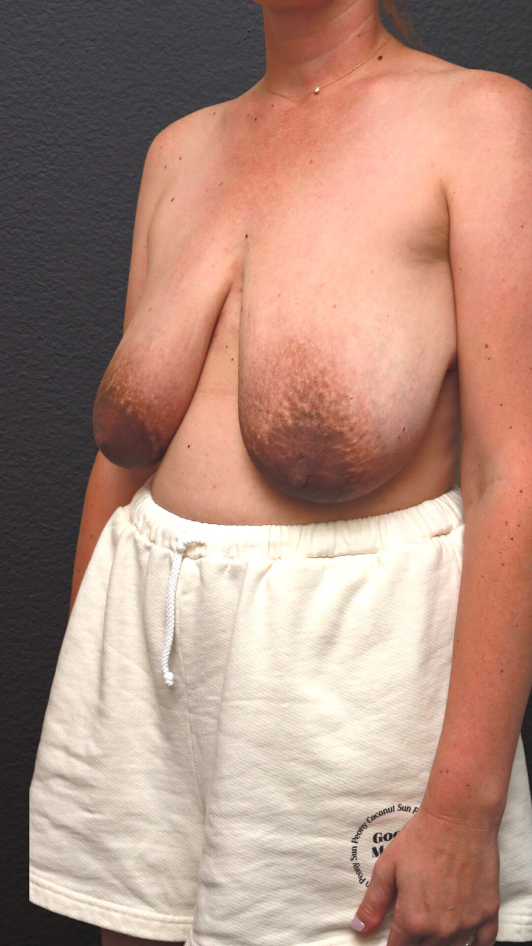 Left Oblique Before