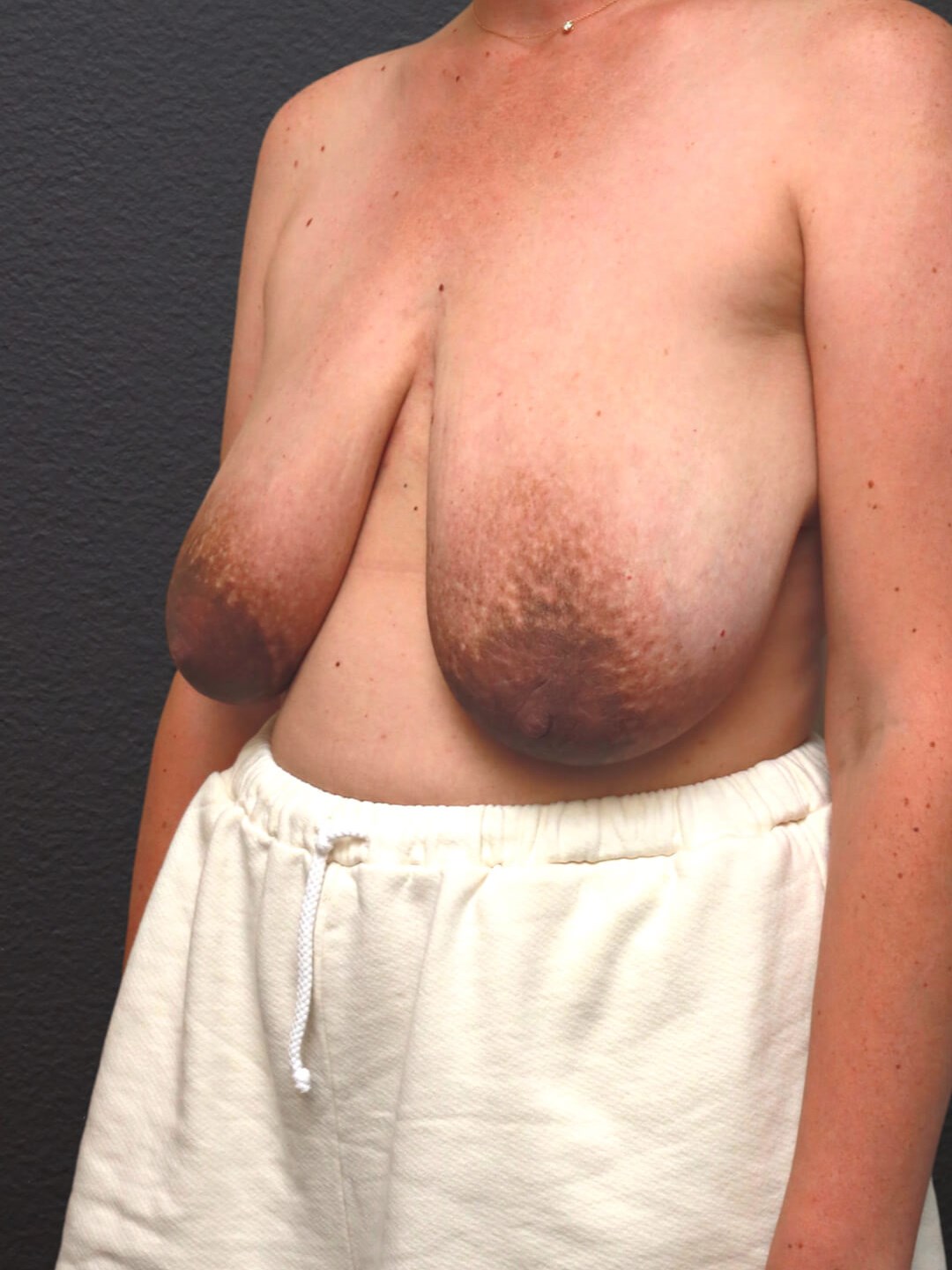Left Oblique Before