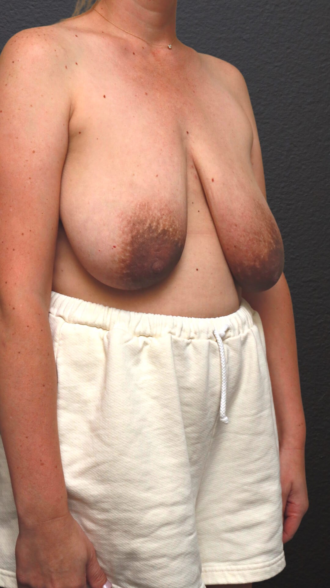 Right Oblique Before