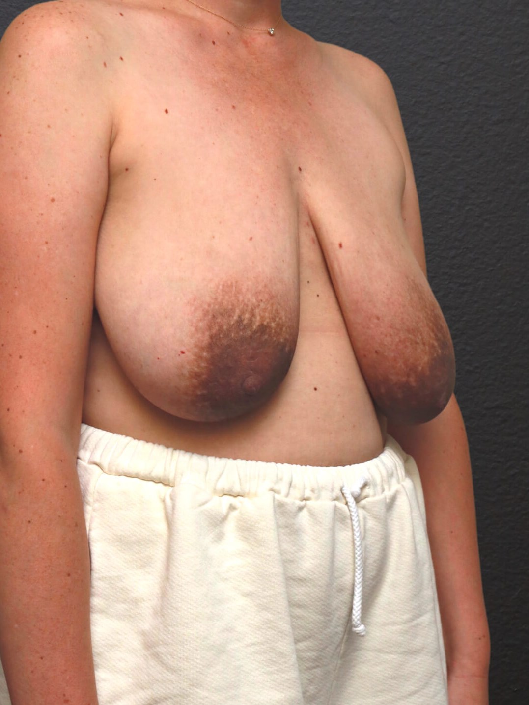 Right Oblique Before
