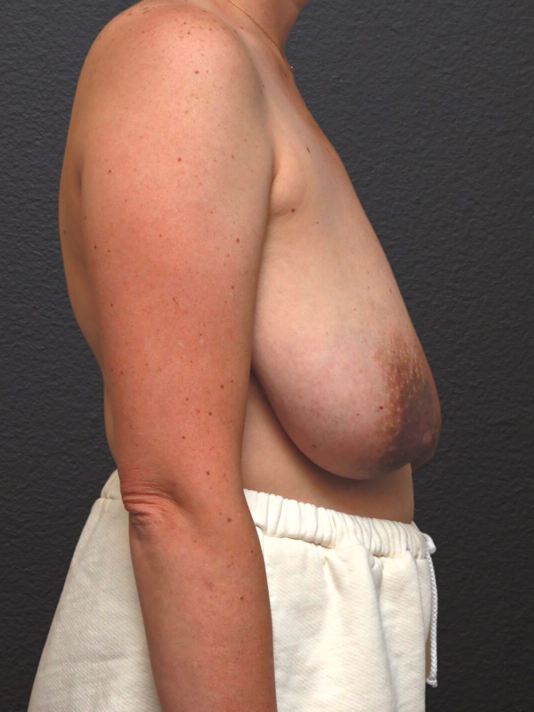 Right Lateral Before