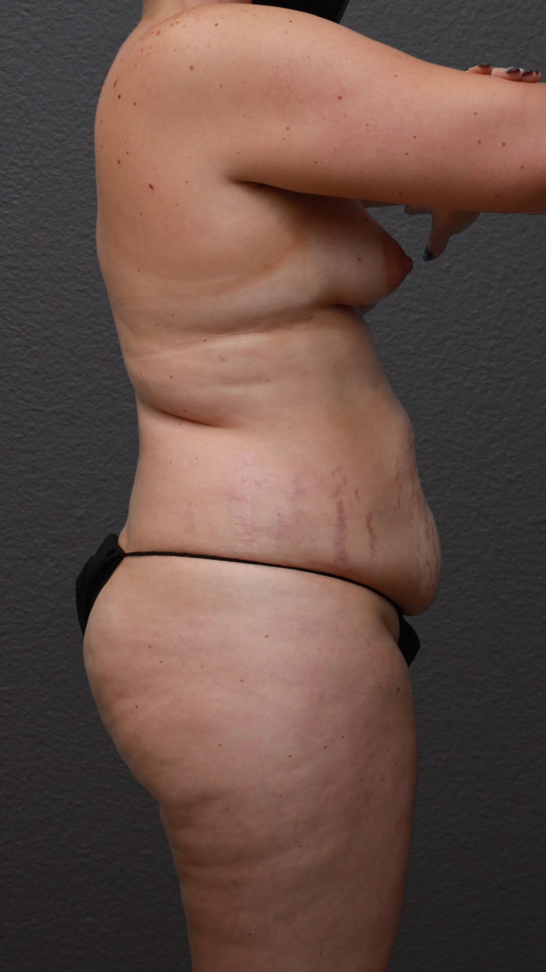 Right Lateral Before