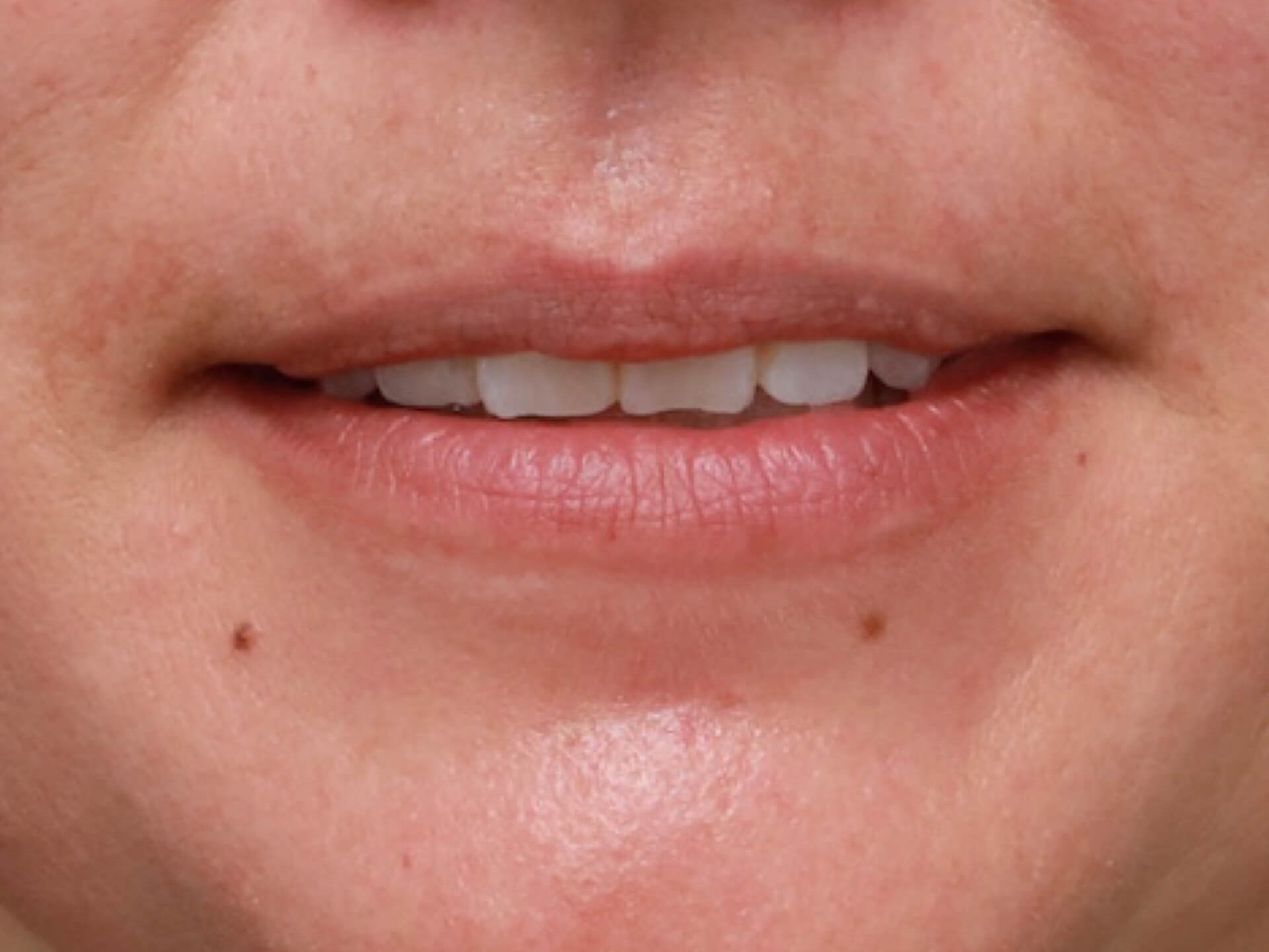 AP Lips Parted Before