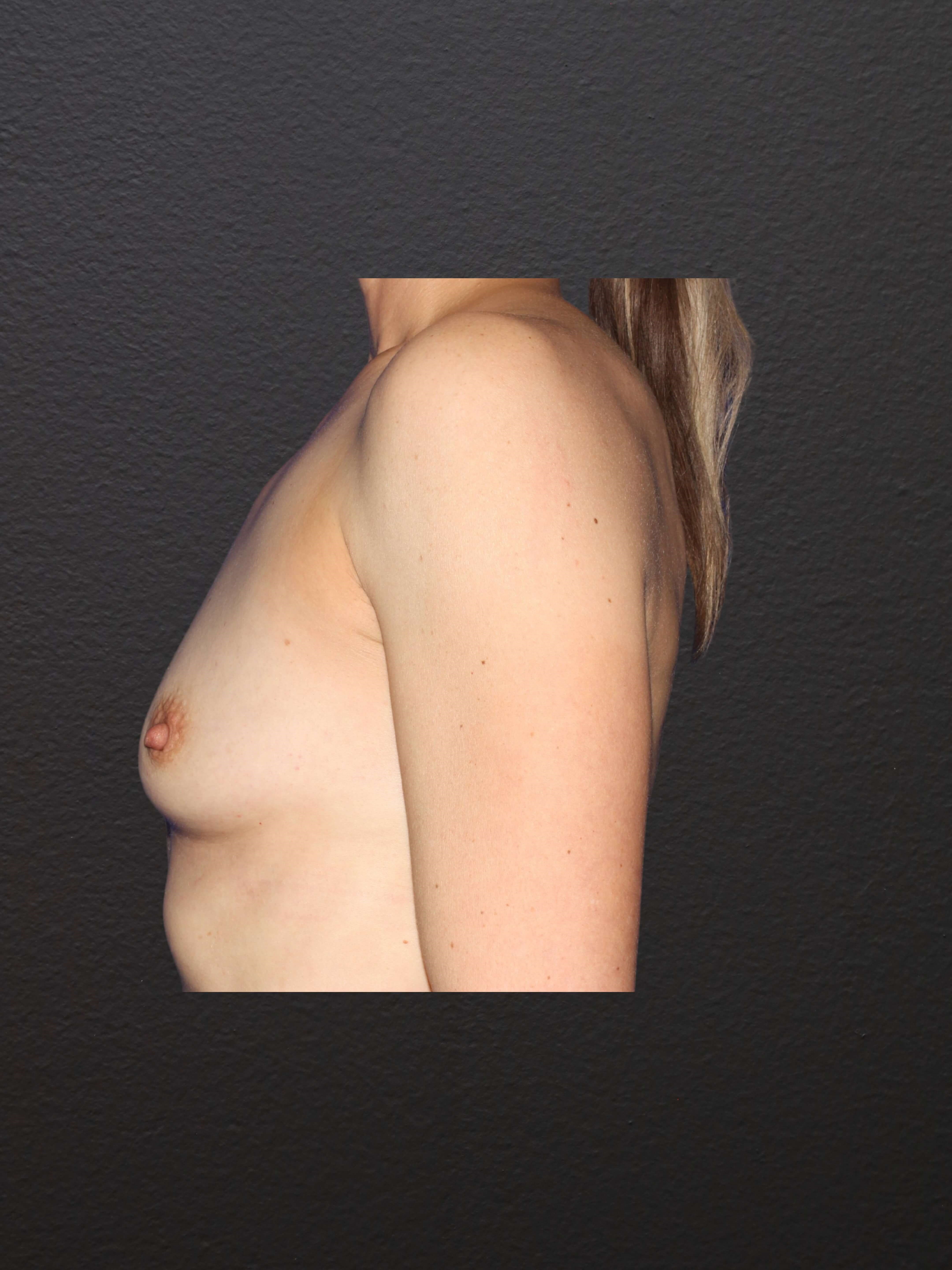 LEFT LATERAL Before