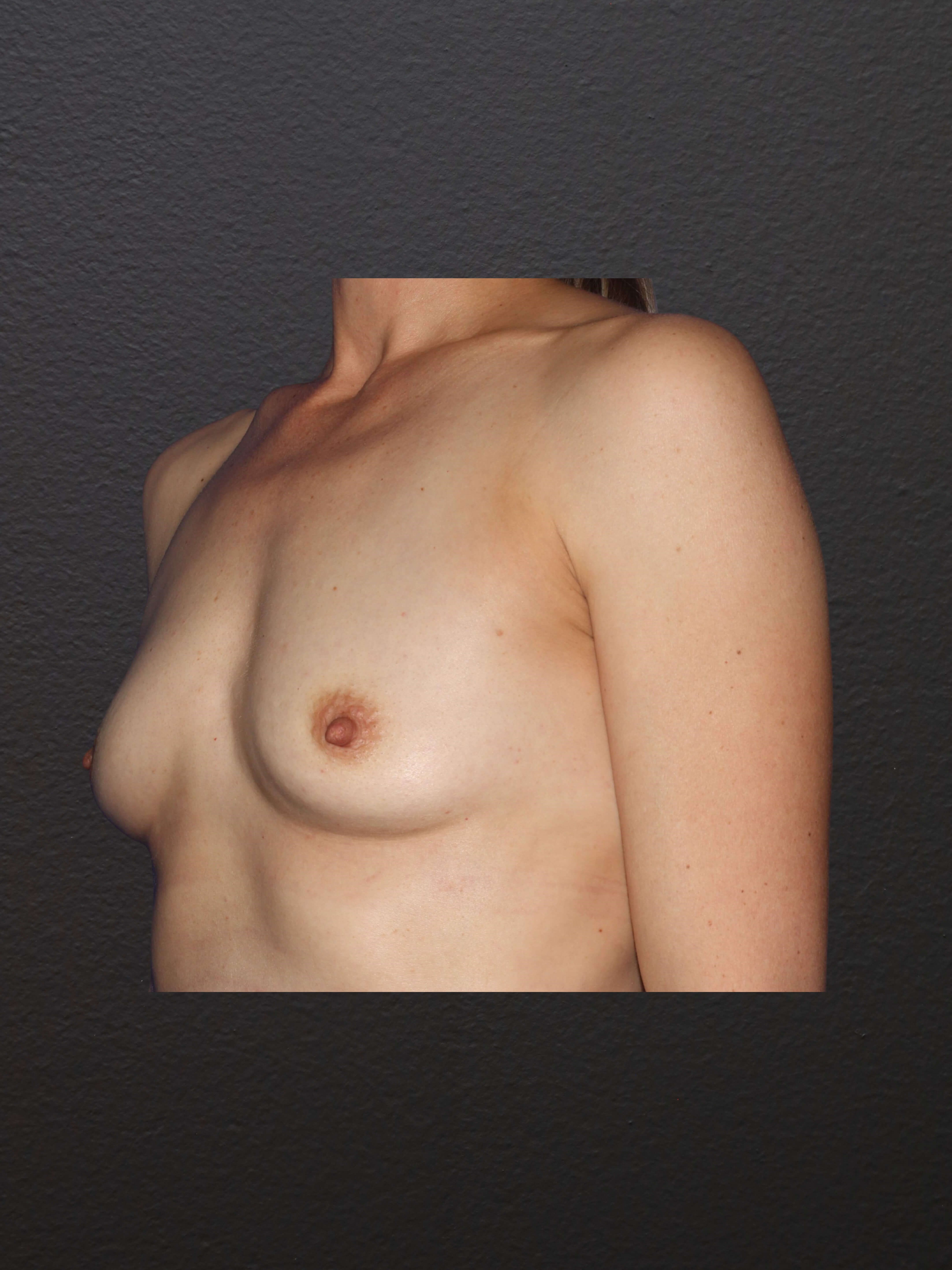 LEFT OBLIQUE Before