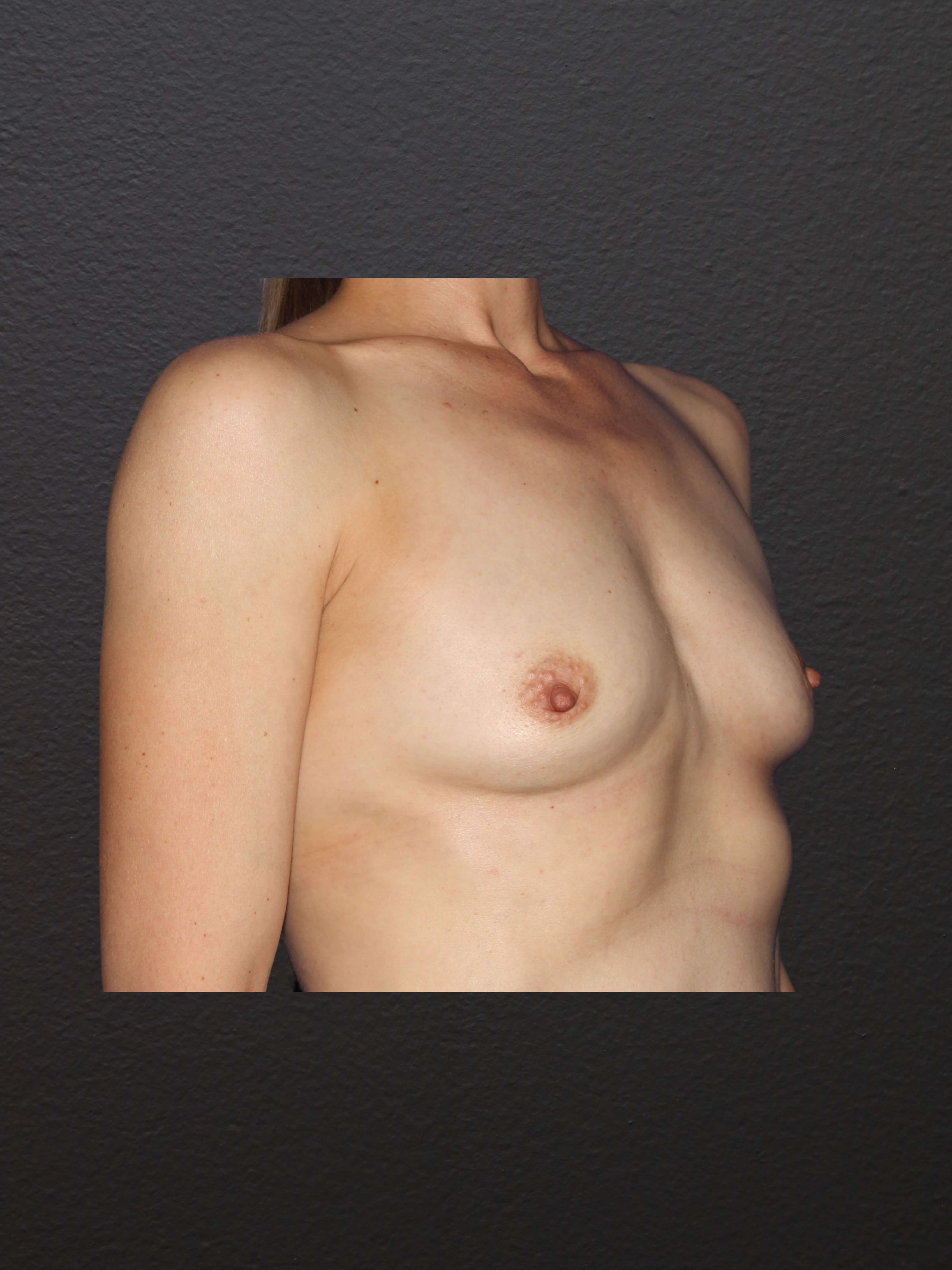 RIGHT OBLIQUE Before