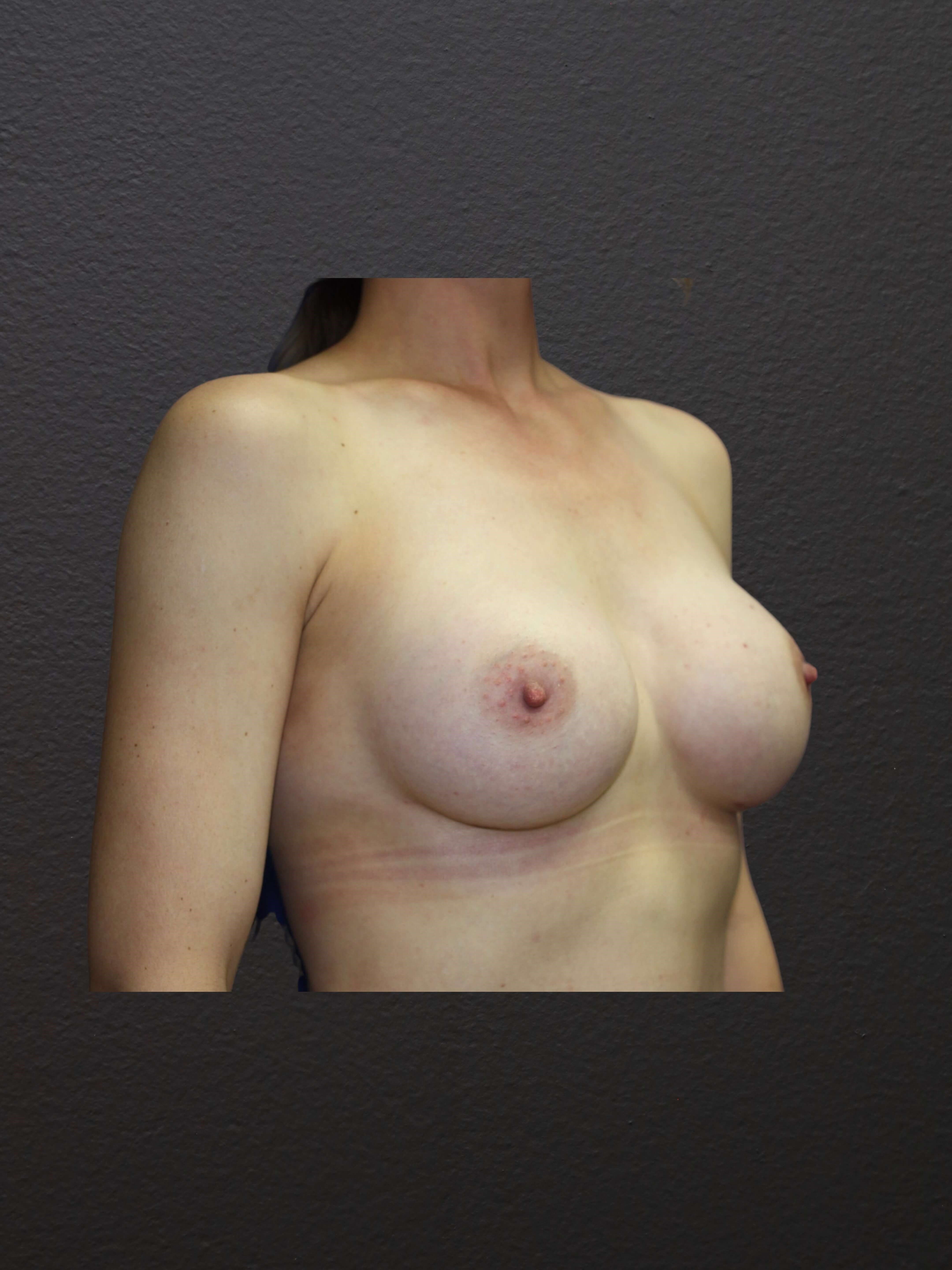 RIGHT OBLIQUE After