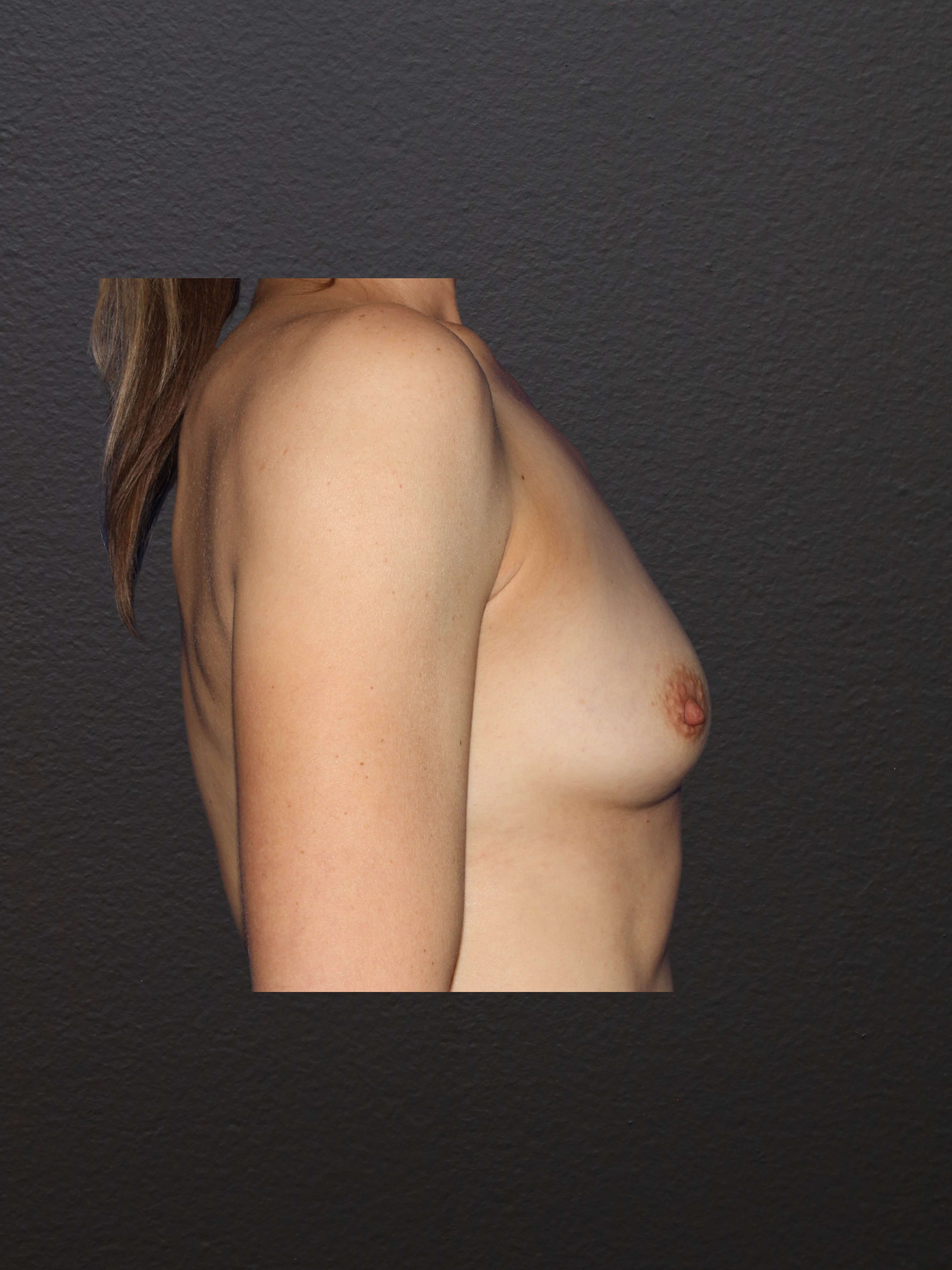 RIGHT LATERAL Before