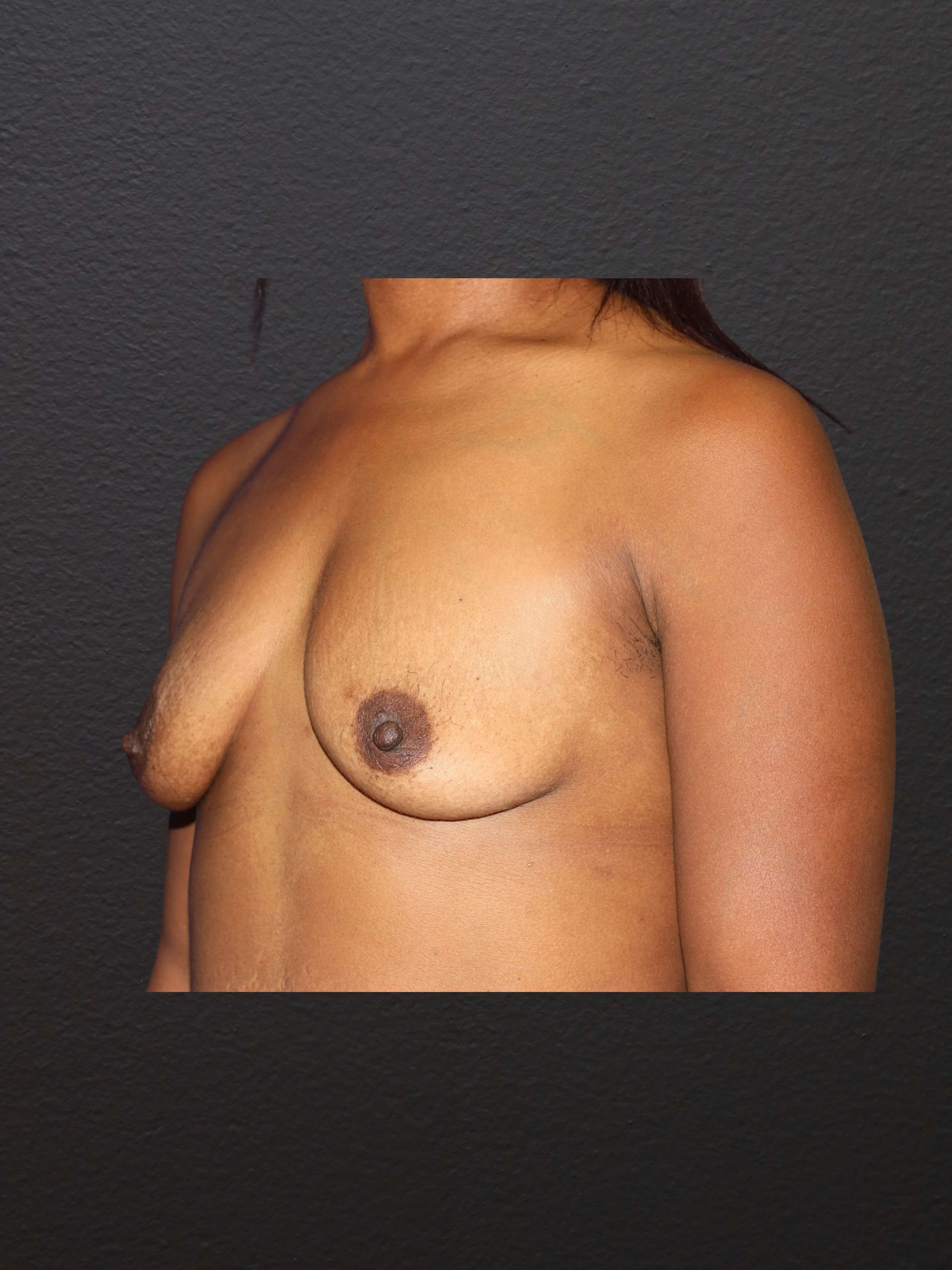 LEFT OBLIQUE Before