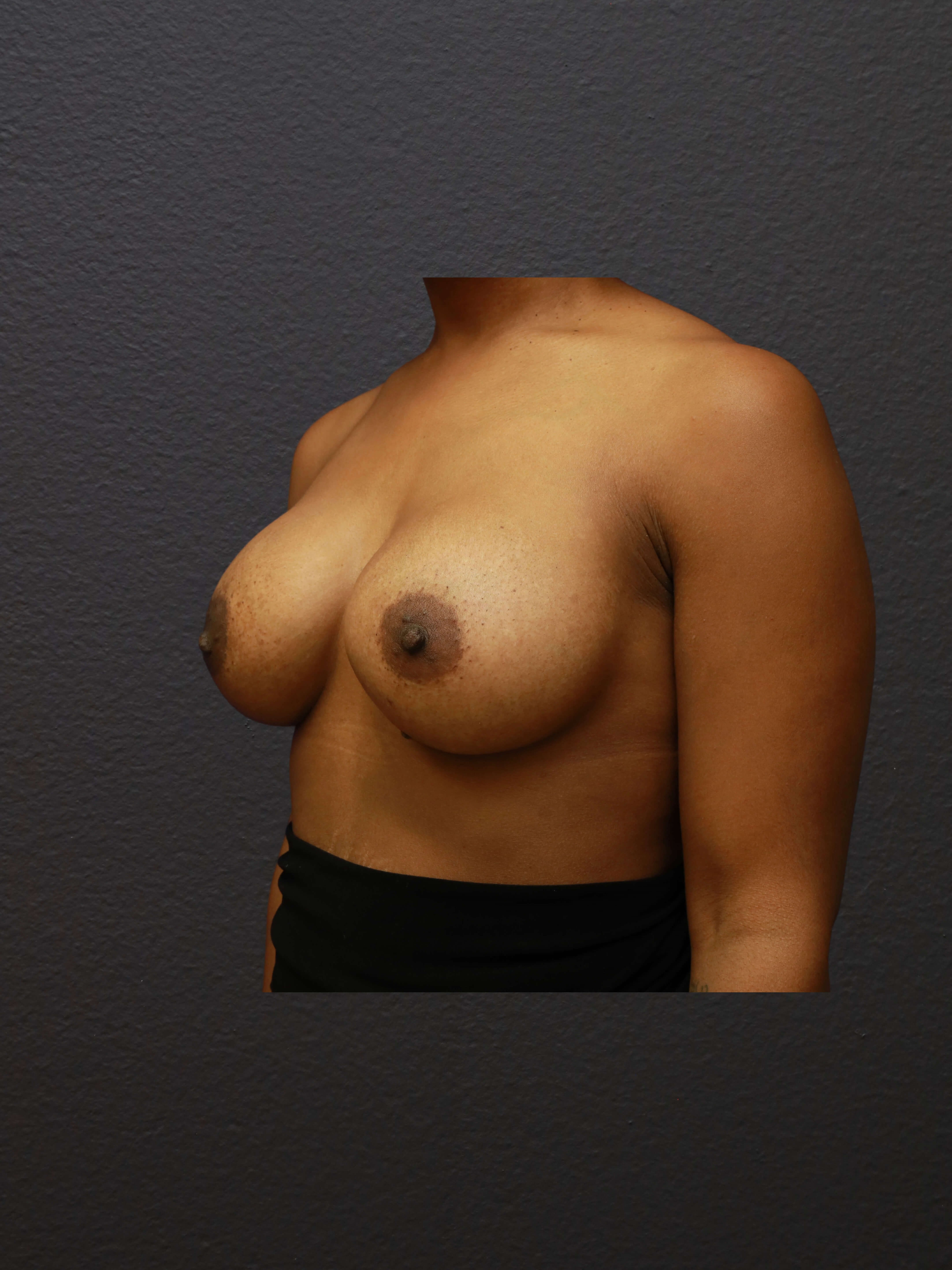 LEFT OBLIQUE After
