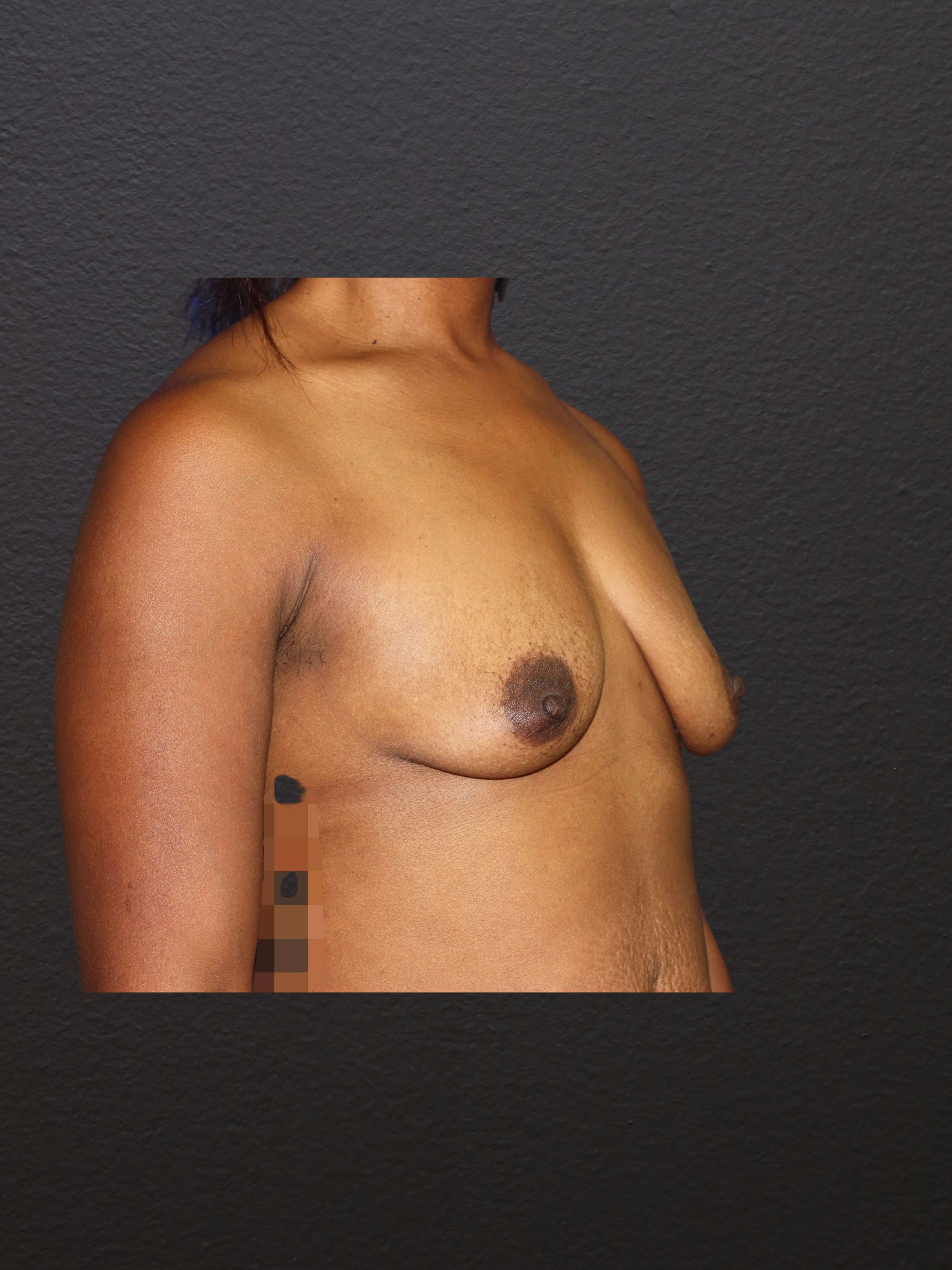 RIGHT OBLIQUE Before
