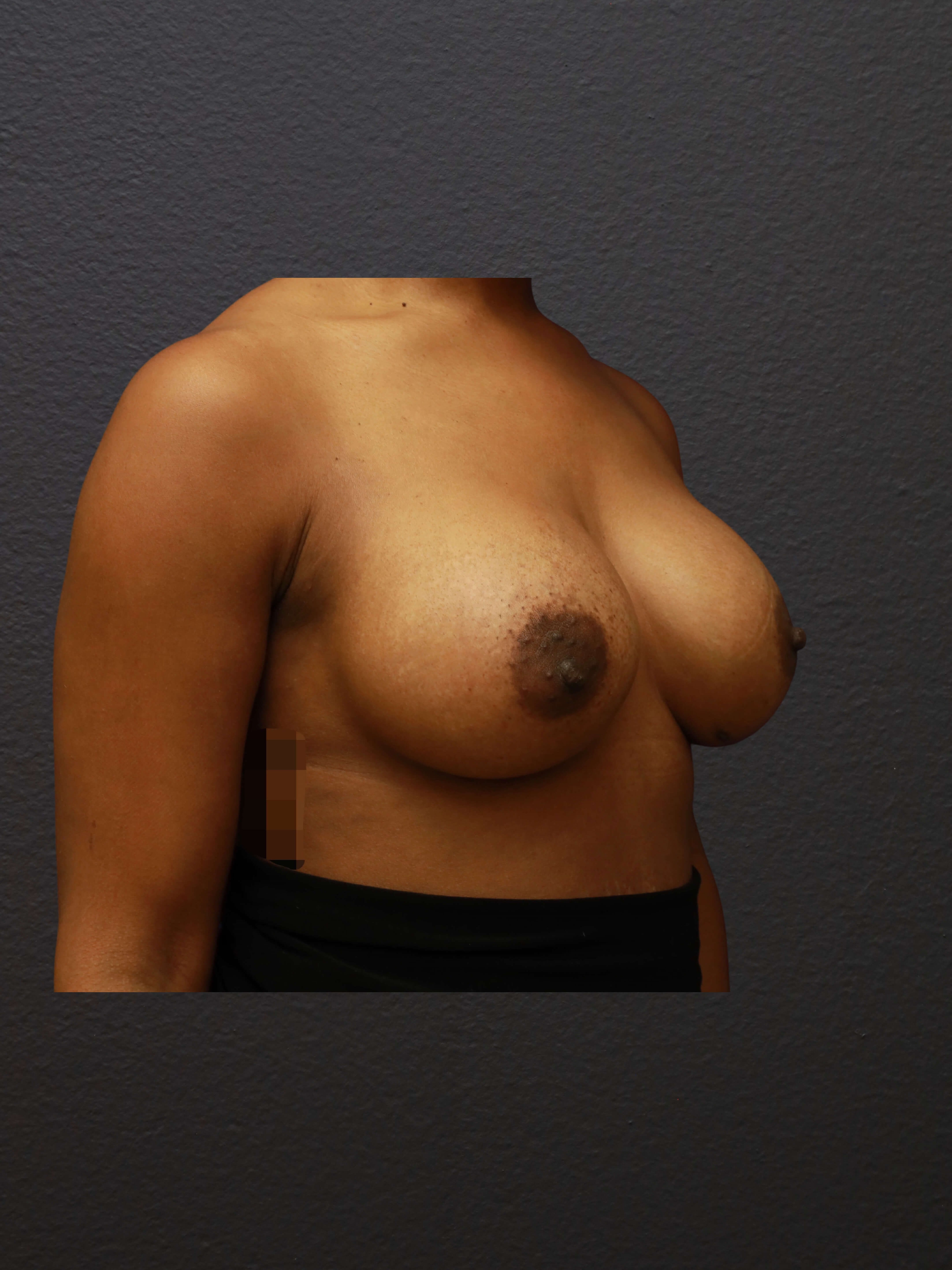 RIGHT OBLIQUE After