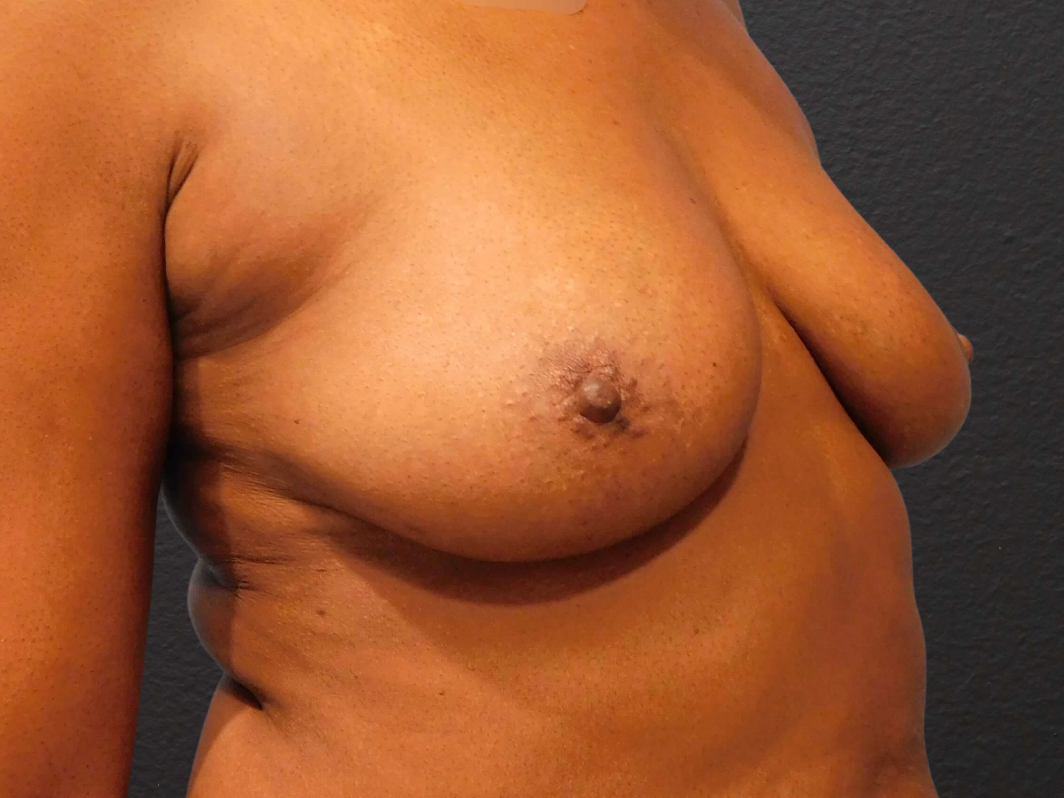 Right Oblique Before