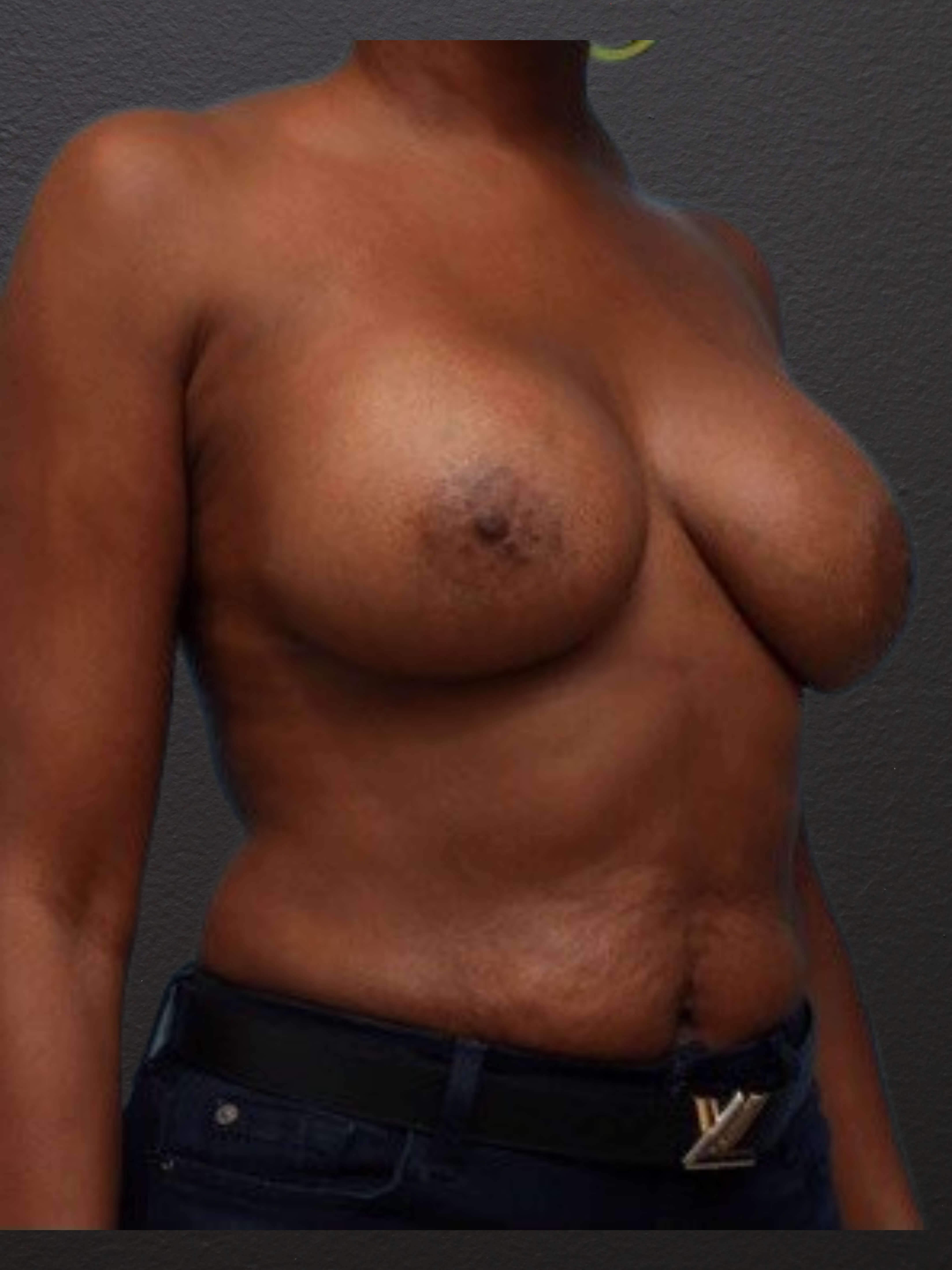 Right Oblique After