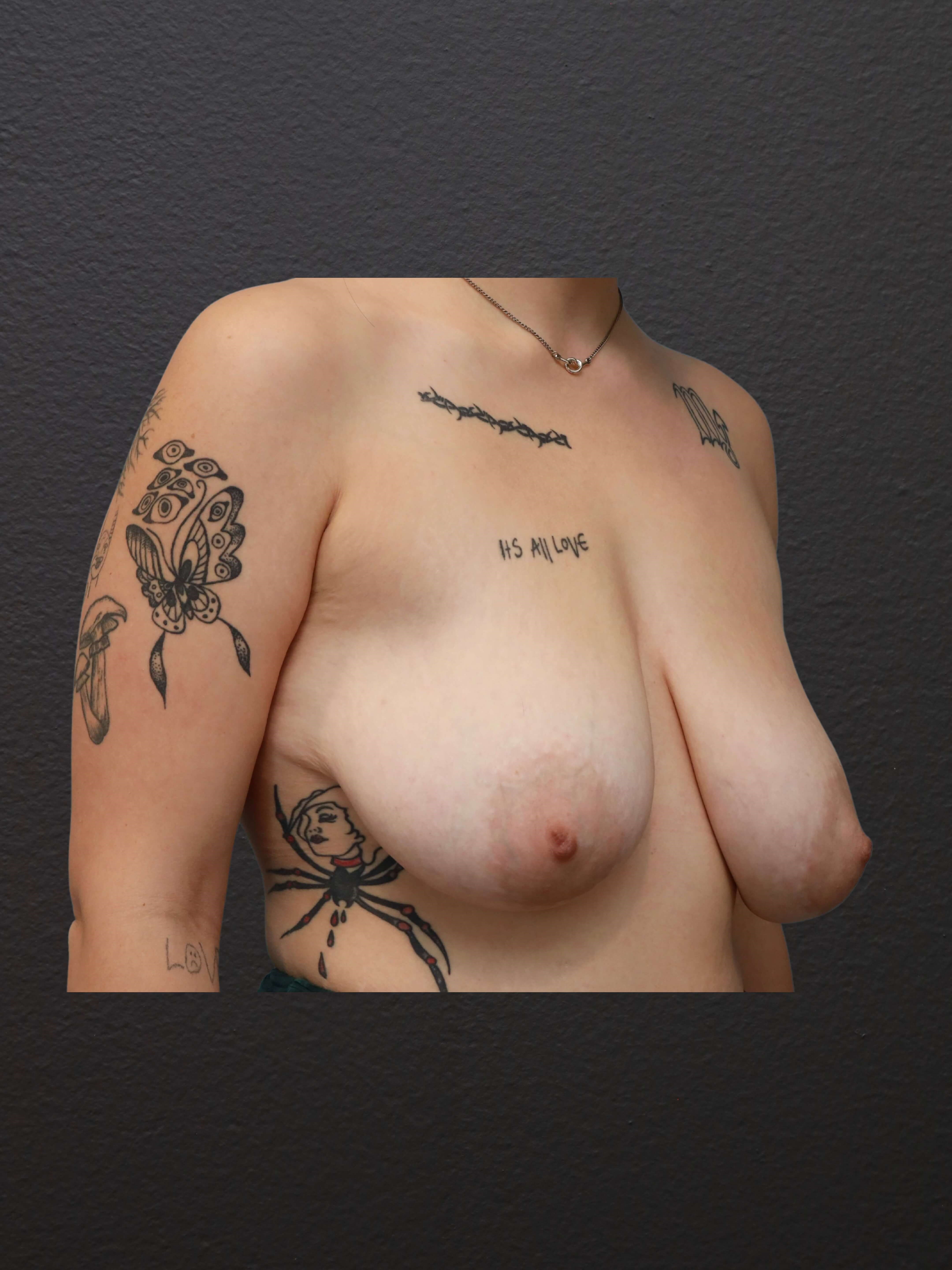 Right Oblique Before