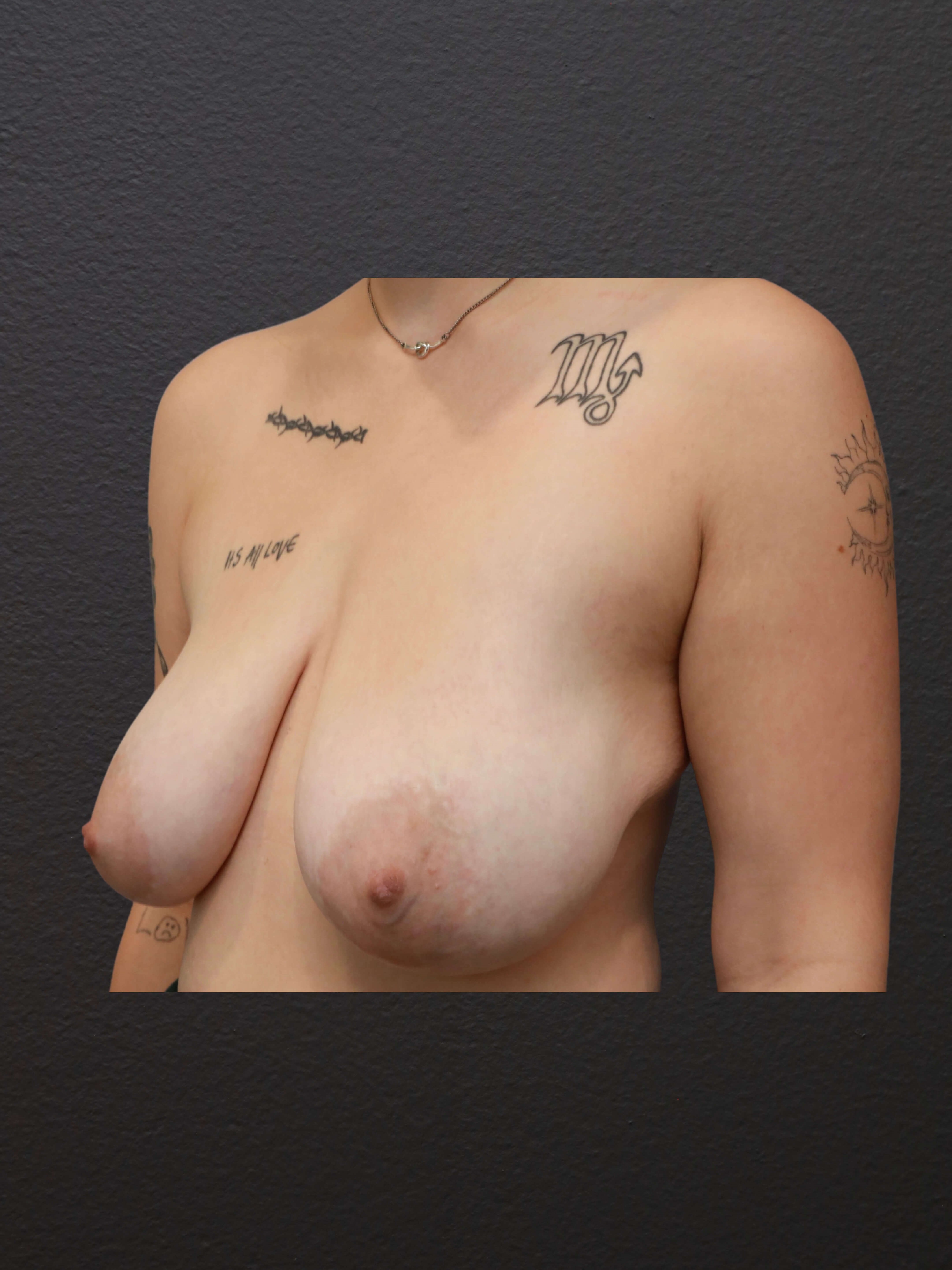 Left Oblique Before