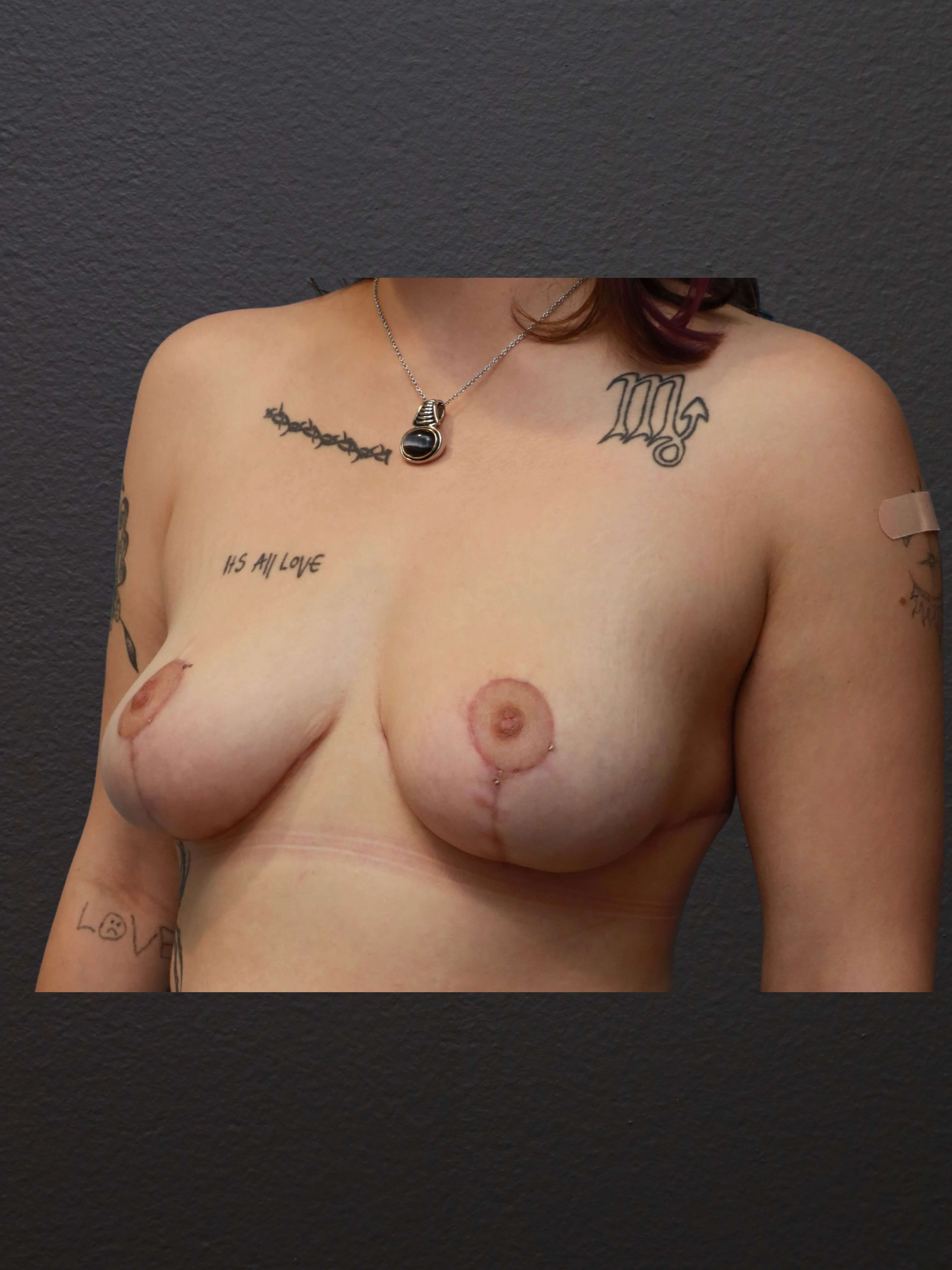 Left Oblique After