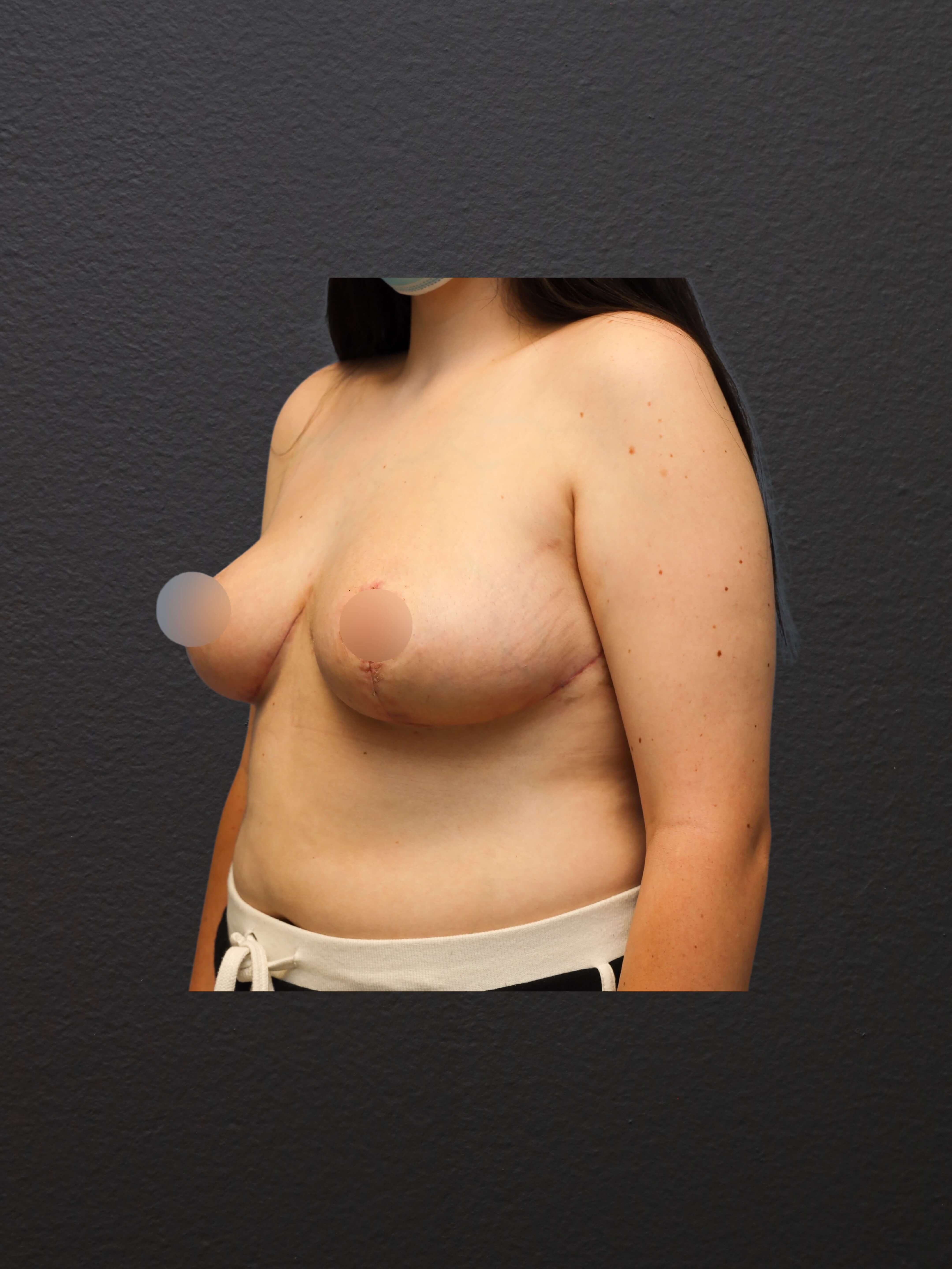 LEFT OBLIQUE After