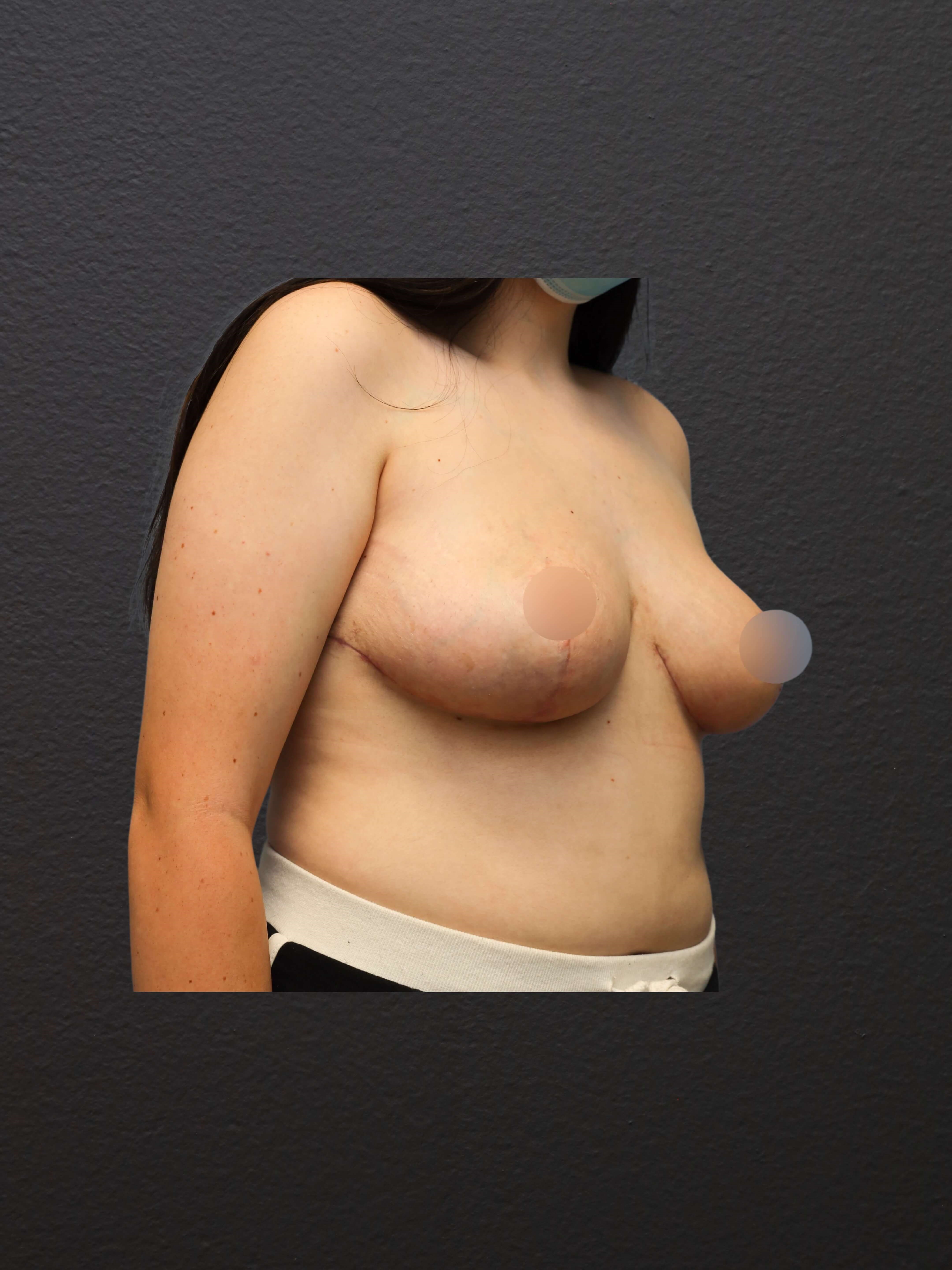 RIGHT OBLIQUE After