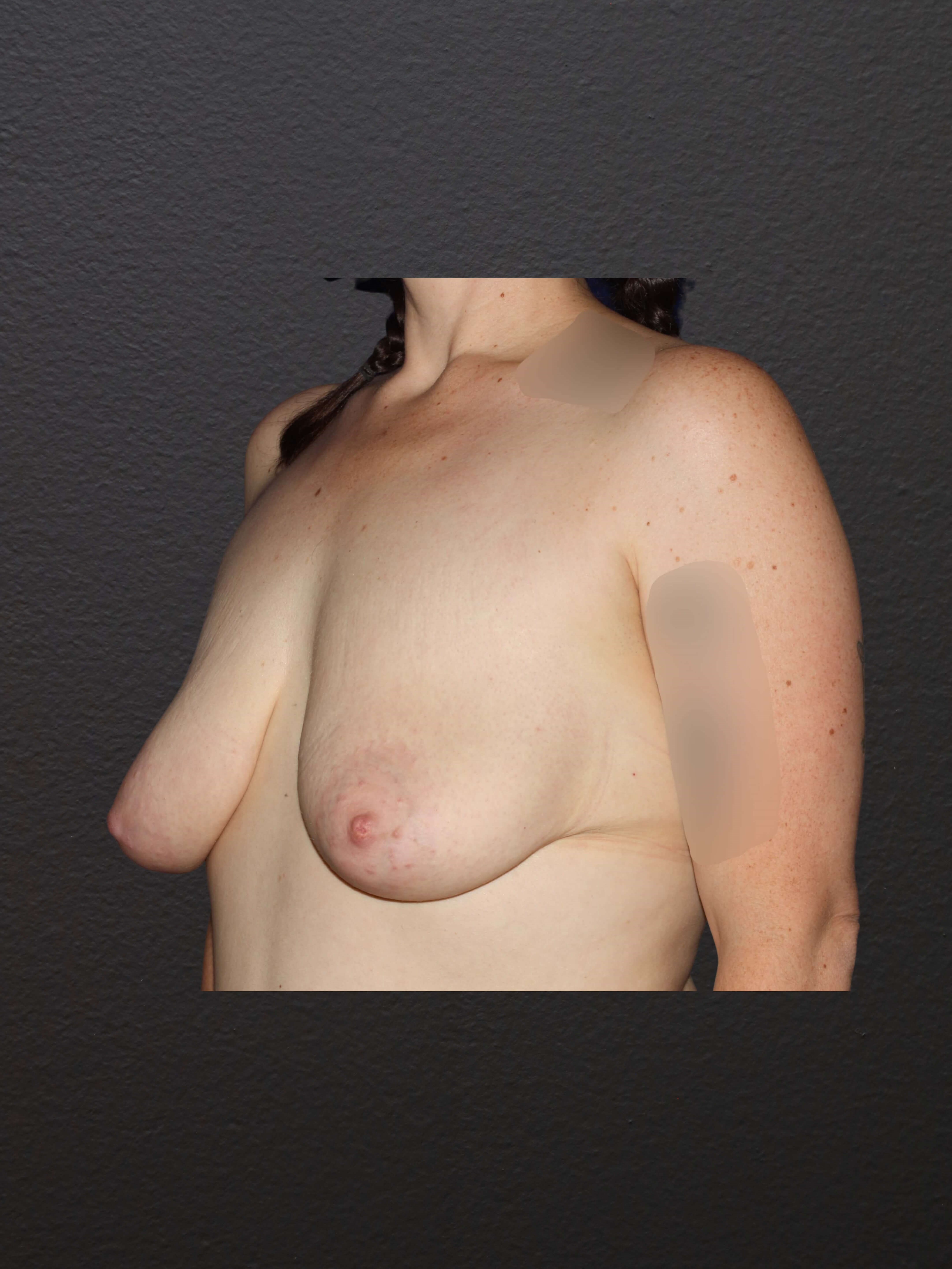 LEFT OBLIQUE Before