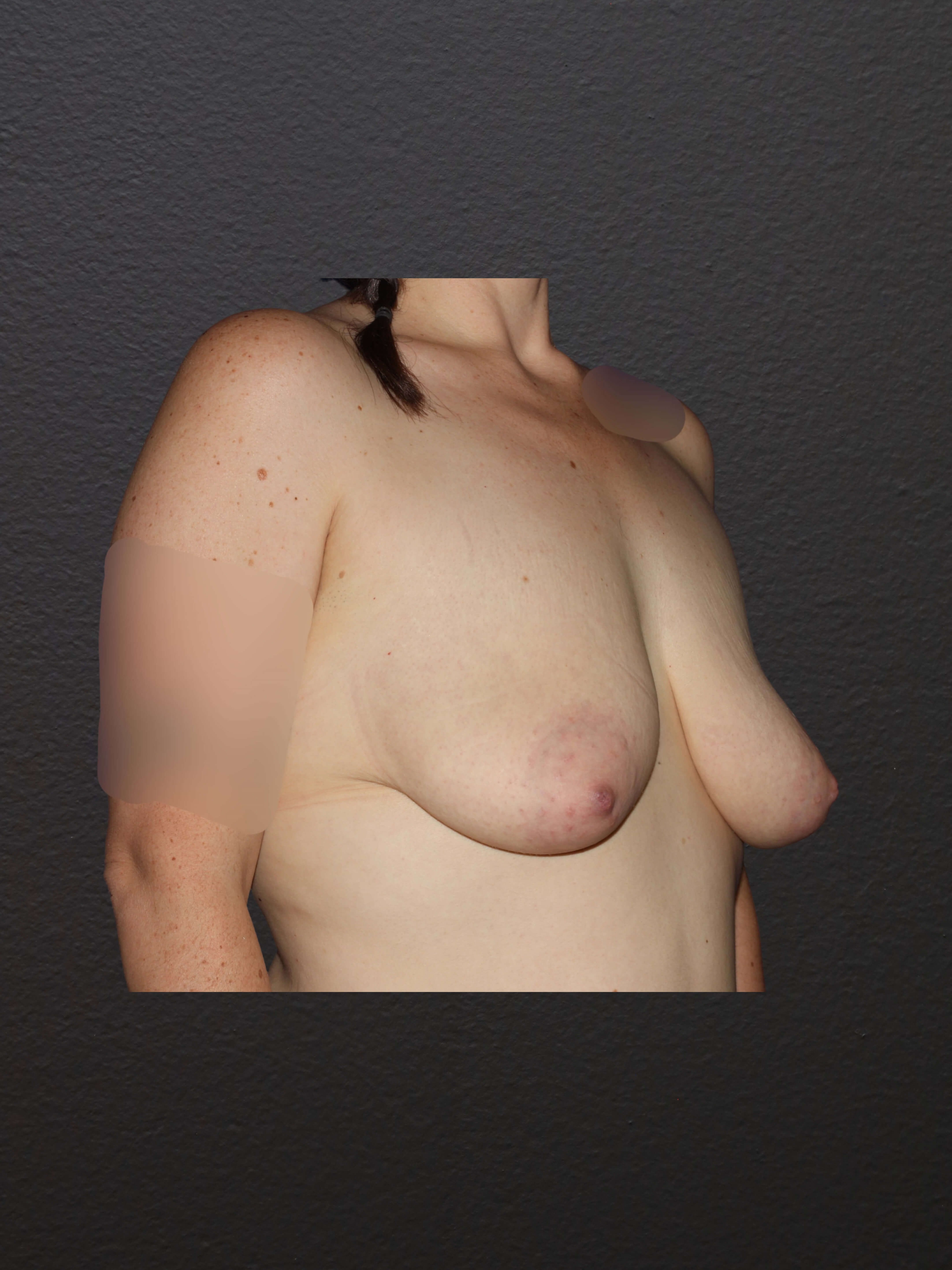 RIGHT OBLIQUE Before