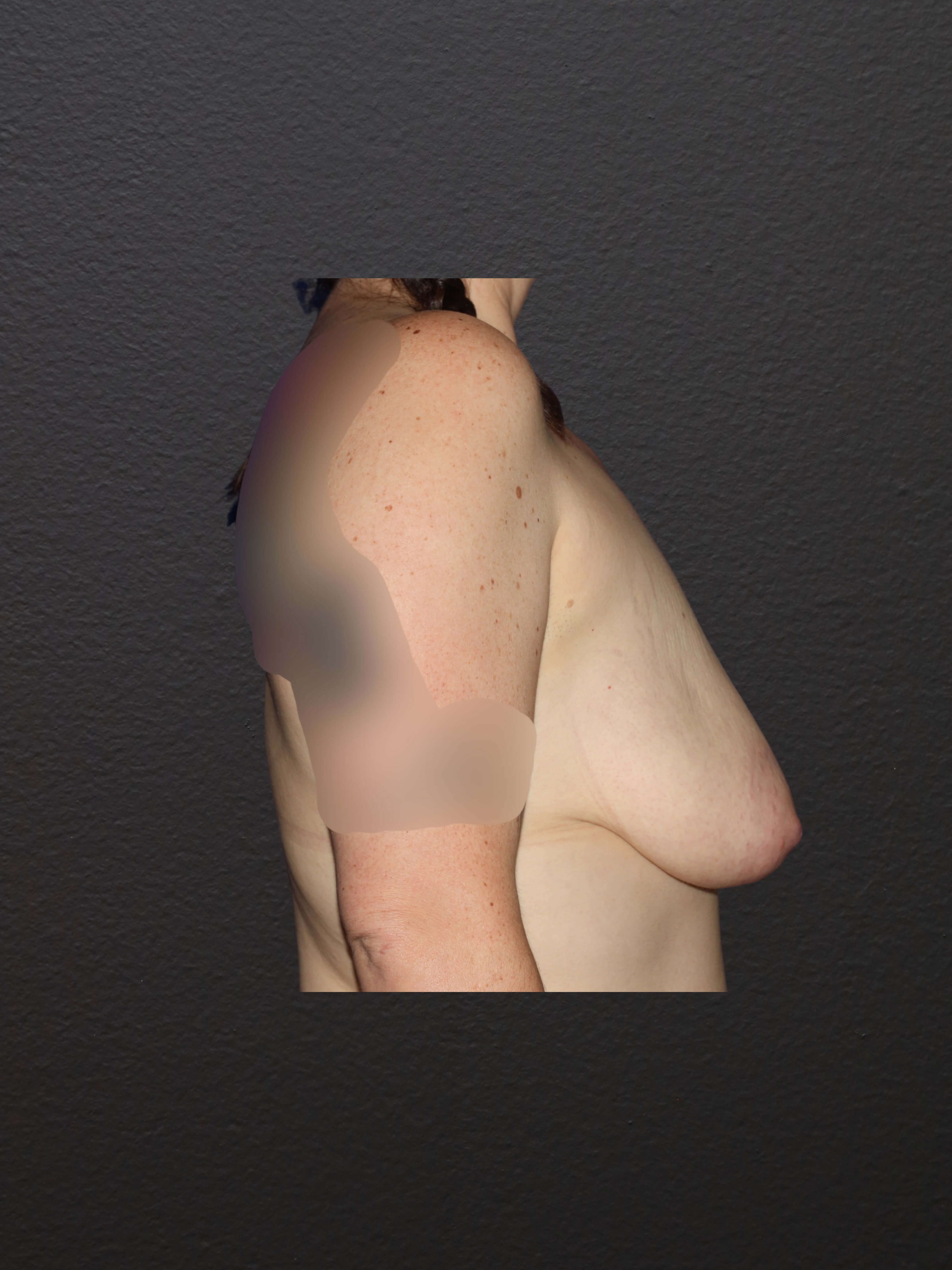 RIGHT LATERAL Before