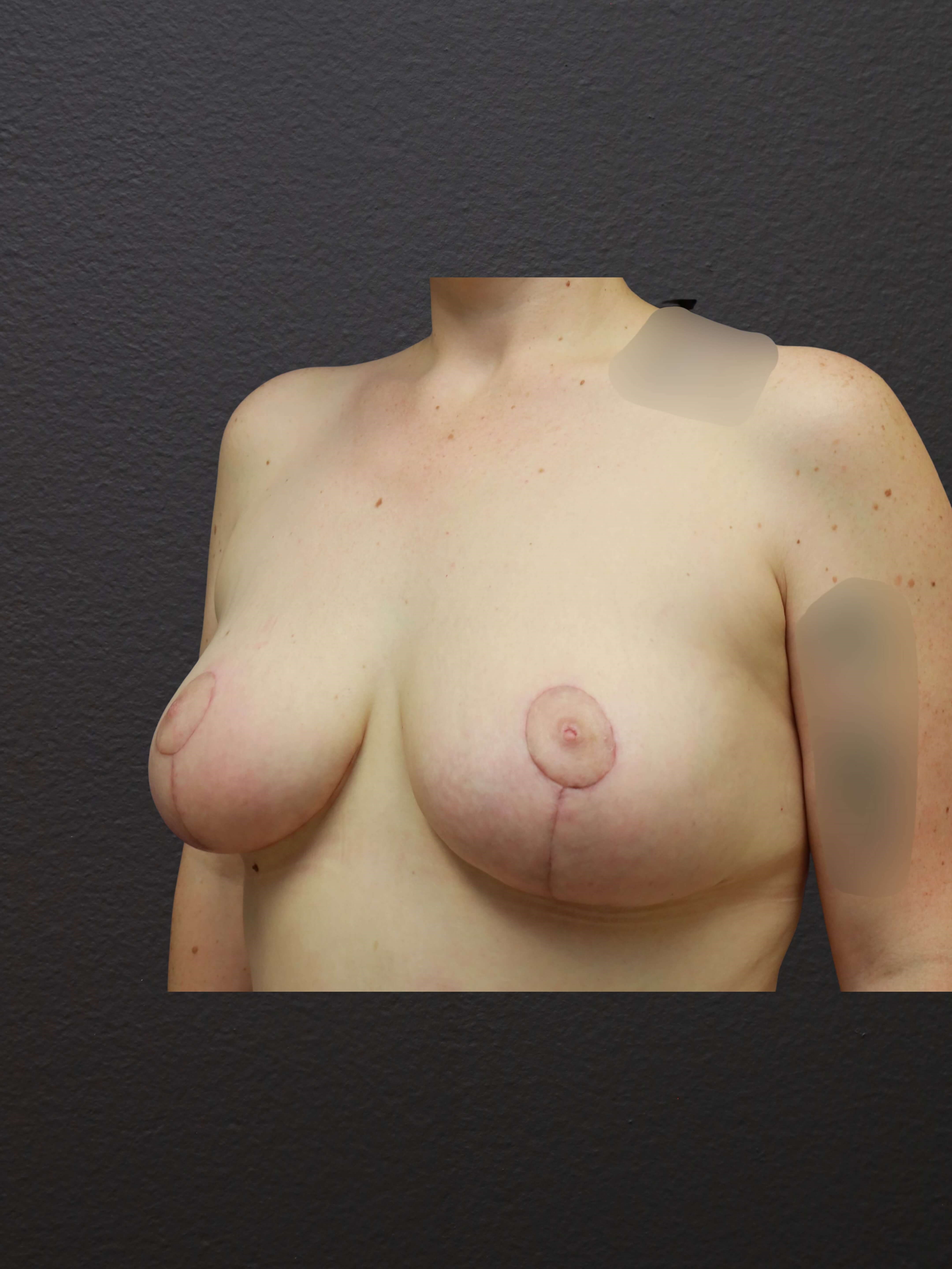 LEFT OBLIQUE After