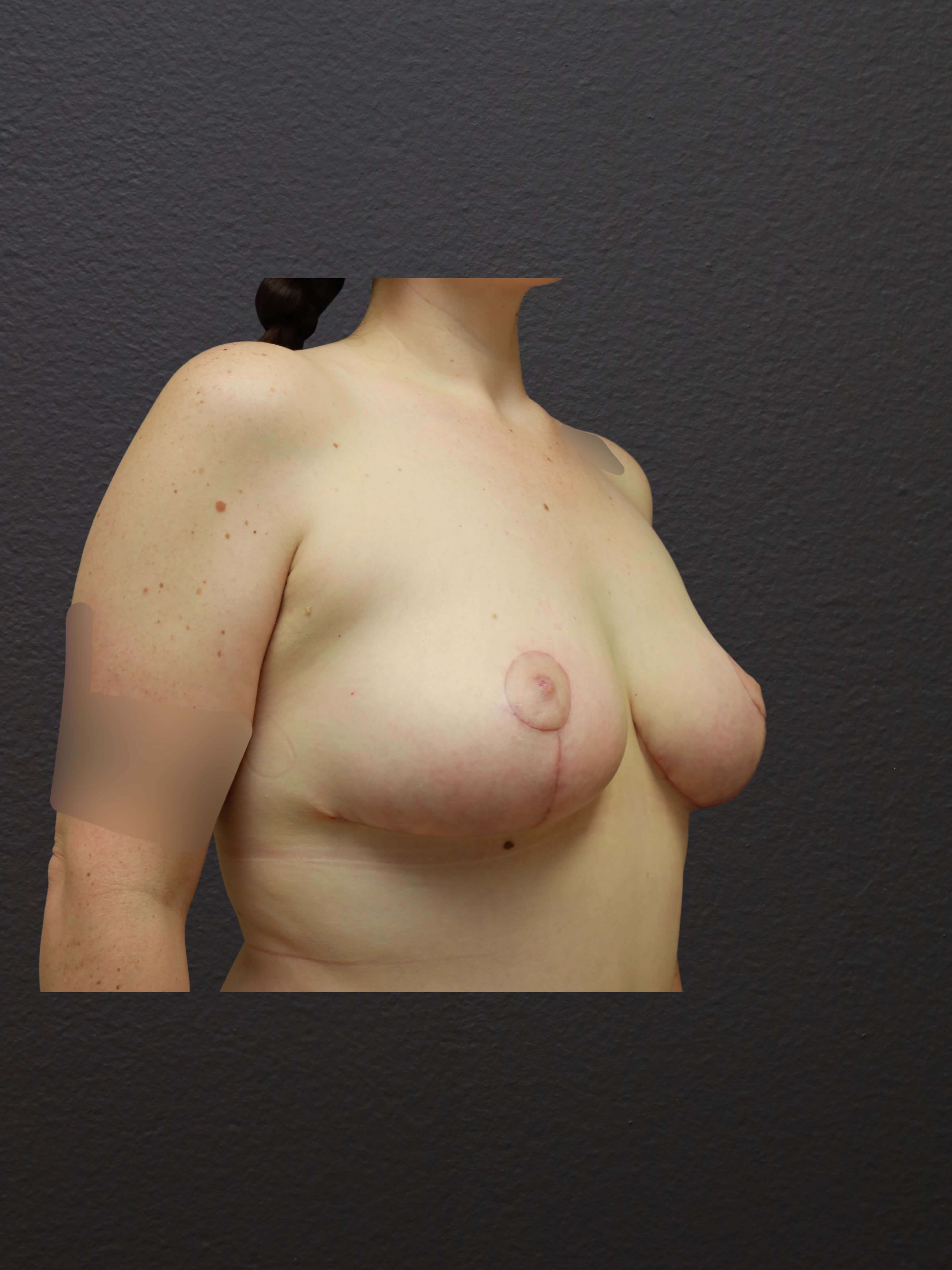 RIGHT OBLIQUE After